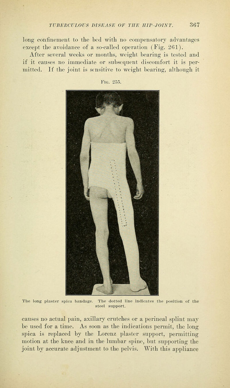 long confinement to the bed with no compensatory advantages except the avoidance of a so-called operation (Fig. 261). After several v^eeks or months, weight bearing is tested and if it causes no immediate or subseqnent discomfort it is per- mitted. If the joint is sensitive to weight bearing, although it Fig. 255. The long plaster spica bandage. The dotted line indicates the position of the steel support. causes no actual pain, axillary crutches or a perineal splint may be used for a time. As soon as the indications permit, the long spica is replaced by the Lorenz plaster support, permitting motion at the knee and in the lumbar spine, but supporting the joint by accurate adjustment to the pelvis. With this appliance