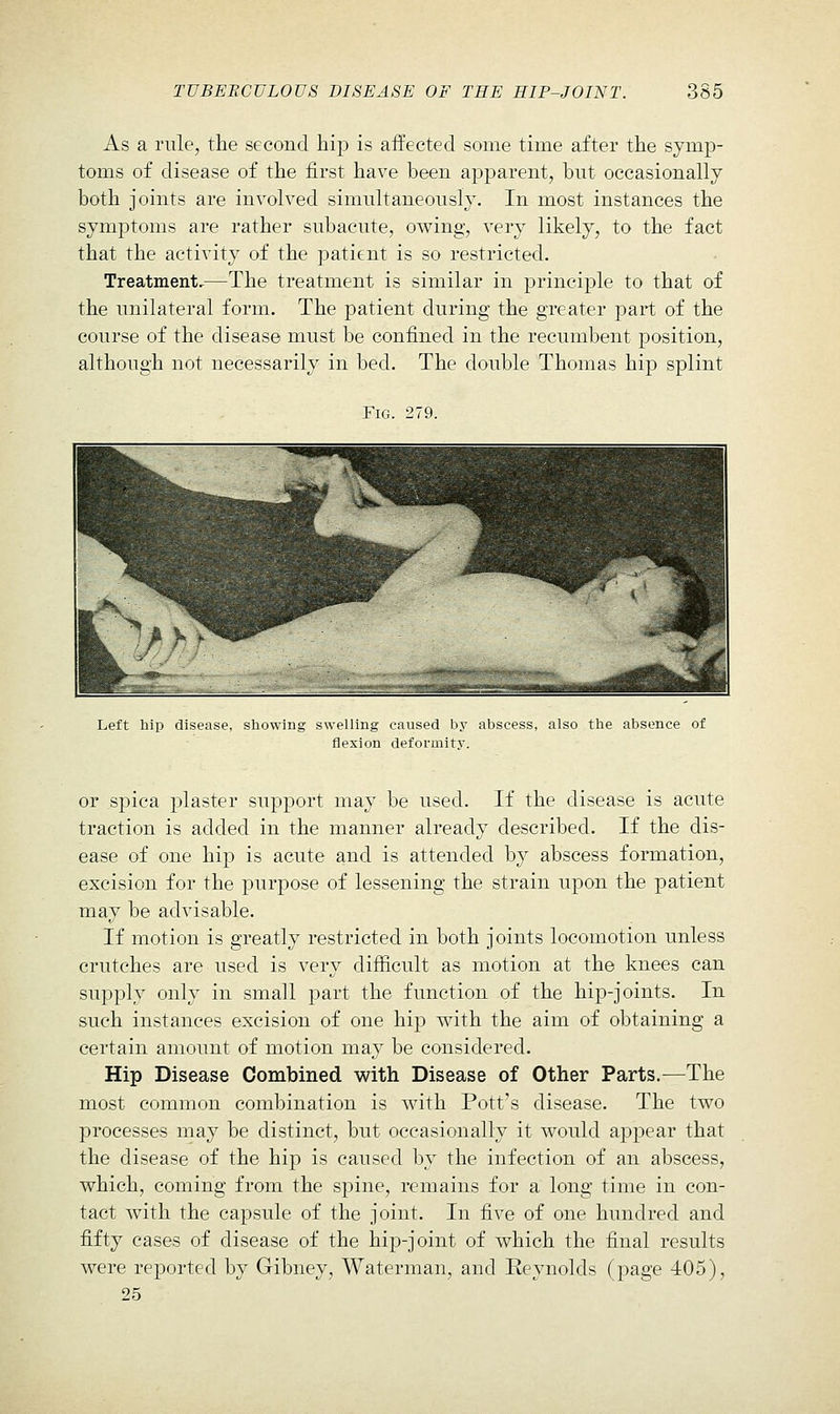 As a rule, the second hip is affected some time after the symp- toms of disease of the first have been apparent, but occasionally both joints are involved simultaneously. In most instances the symptoms are rather subacute, owing, very likely, to the fact that the activity of the patient is so restricted. Treatment,—The treatment is similar in principle to that of the unilateral form. The patient during the greater part of the course of the disease must be confined in the recumbent position, although not necessarily in bed. The double Thomas hip splint Fig. 279. Left hip disease, shuwiiu swelling caused by abscess, also the absence of flexion deformity. or spica plaster support may be used. If the disease is acute traction is added in the manner already described. If the dis- ease of one hip is acute and is attended by abscess formation, excision for the purpose of lessening the strain upon the patient may be advisable. If motion is greatly restricted in both joints locomotion unless crutches are used is very difficult as motion at the knees can supply only in small part the function of the hip-joints. In such instances excision of one hip with the aim of obtaining a certain amount of motion may be considered. Hip Disease Combined with Disease of Other Parts.—The most common combination is with Pott's disease. The two processes may be distinct, but occasionally it would appear that the disease of the hip is caused by the infection of an abscess, which, coming from the spine, remains for a long time in con- tact with the capsule of the joint. In five of one hundred and fifty cases of disease of the hip-joint of which the final results were reported by Gibney, Waterman, and Reynolds (page 405), 25