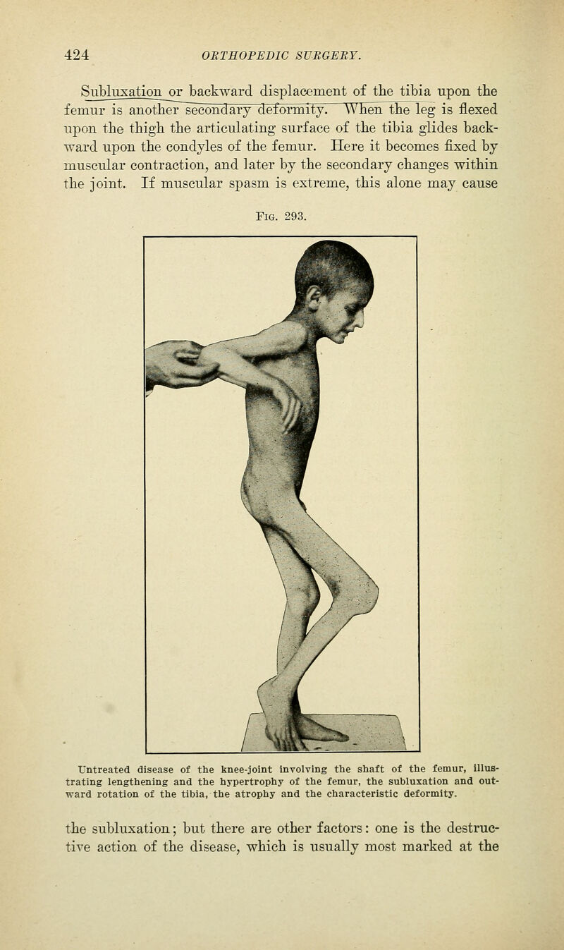 Subluxation or backward displacement of the tibia upon the femur is anotheriecondary deformity. WFen tEe leg is flexed upon the thigh the articulating surface of the tibia glides back- ward upon the condyles of the femur. Here it becomes fixed by muscular contraction, and later by the secondary changes within the joint. If muscular spasm is extreme, this alone may cause Fig. 293. Untreated disease of the knee-joint involving tlie shaft of the femur, illus- trating lengthening and the hypertrophy of the femur, the subluxation and out- ward rotation of the tibia, the atrophy and the characteristic deformity. the subluxation; but there are other factors: one is the destruc- tive action of the disease, which is usually most marked at the