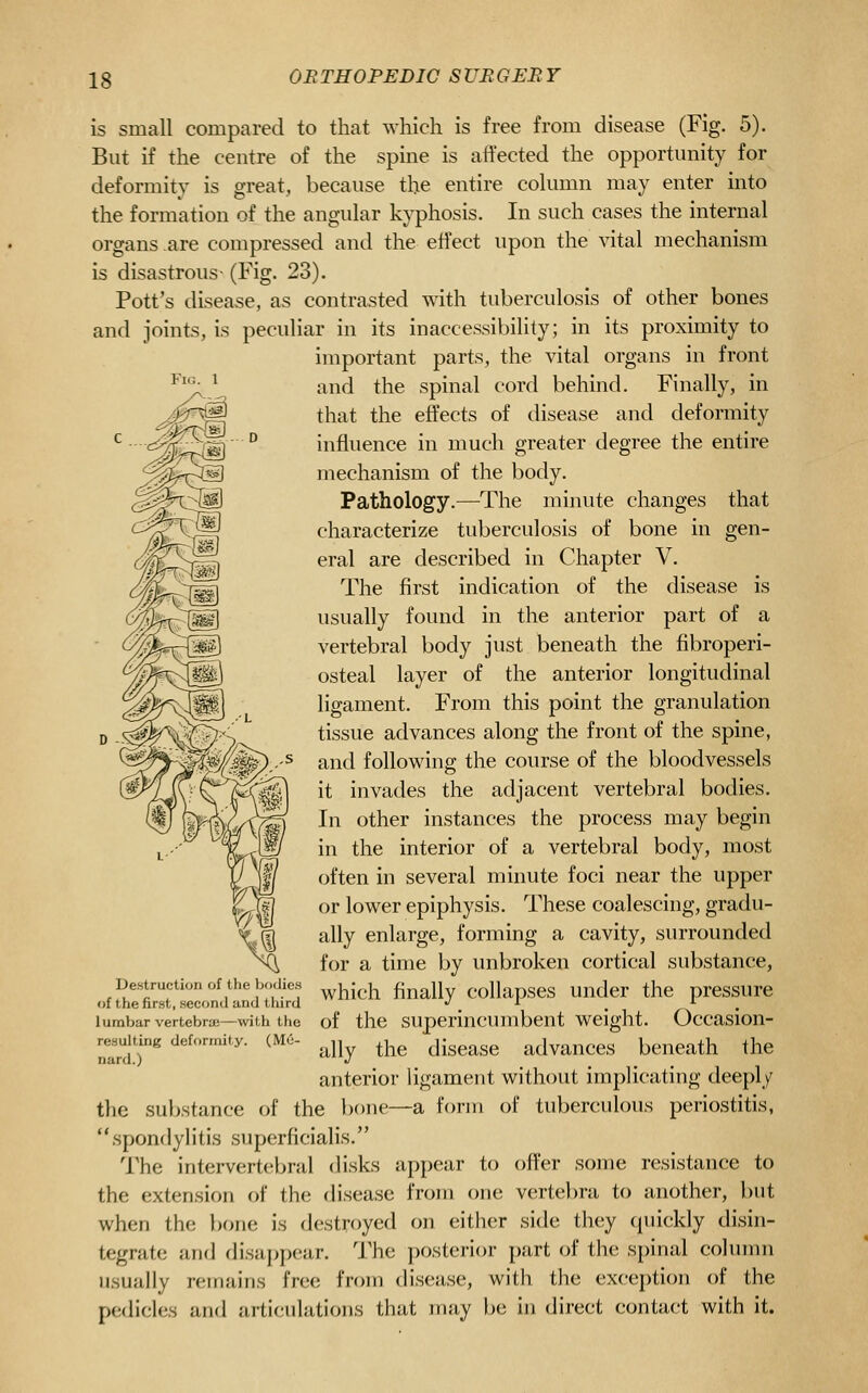 OB TH OPE DIG SURGERY is small compared to that which is free from disease (Fig. 5). But if the centre of the spine is affected the opportunity for deformity is great, because the entire column may enter into the formation of the angular kyphosis. In such cases the internal organs are compressed and the effect upon the vital mechanism is disastrous- (Fig. 23). Pott's disease, as contrasted with tuberculosis of other bones and joints, is peculiar in its inaccessibility; in its proximity to important parts, the vital organs in front and the spinal cord behind. Finally, in that the effects of disease and deformity influence in much greater degree the entire mechanism of the body. Pathology.—The minute changes that characterize tuberculosis of bone in gen- eral are described in Chapter V. The first indication of the disease is usually found in the anterior part of a vertebral body just beneath the fibroperi- osteal layer of the anterior longitudinal ligament. From this point the granulation tissue advances along the front of the spine, and following the course of the bloodvessels it invades the adjacent vertebral bodies. In other instances the process may begin in the interior of a vertebral body, most often in several minute foci near the upper or lower epiphysis. These coalescing, gradu- ally enlarge, forming a cavity, surrounded for a time by unbroken cortical substance, which finally collapses under the pressure lumbar vertebra;—with the of the supcrincumbent Weight. Occasiou- re^«uiting deformity. (M6- ^jj^ ^^^ discasc advauccs beneath the anterior ligament without implicating deeply the su})stance of the bone—a form of tuberculous periostitis, spondylitis superficialis. The intervertebral disks appear to offer some resistance to the extension of the disease from one vertel)ra to another, but when the bone is destroyed on either side they quickly disin- tegrate and disappear. The posterior part of the spinal column usually remains free from disease, with the exception of the pedicles and articulations that may be in direct contact with it. Destruction of the bodies of the first, second and third