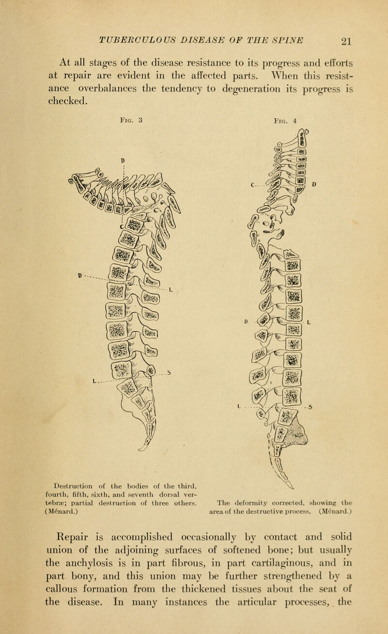At all stages of the disease resistance to its progress antl eft'orts at repair are evident in the affected parts. When this resist- ance overbalances the tendency to degeneration its progress is checked. Fig. 3 Fig. 4 tO@ iM> Destruction of the bodies of the third, fourth, fifth, .sixth, and seventh dors^al ver- tebne; partial destruction of tlirec others. ( M6nard.) The deformity corrected, .show-ing the area of the destructive process. (Menard.) Repair is accomplished occasionally by contact and solid union of the adjoining surfaces of softened bone; but usually the anchylosis is in part fibrous, in part cartilaginous, and in part bony, and this union may be further strengthened by a callous formation from the thickened tissues about the seat of the disease. In many instances the articular processes, tlie