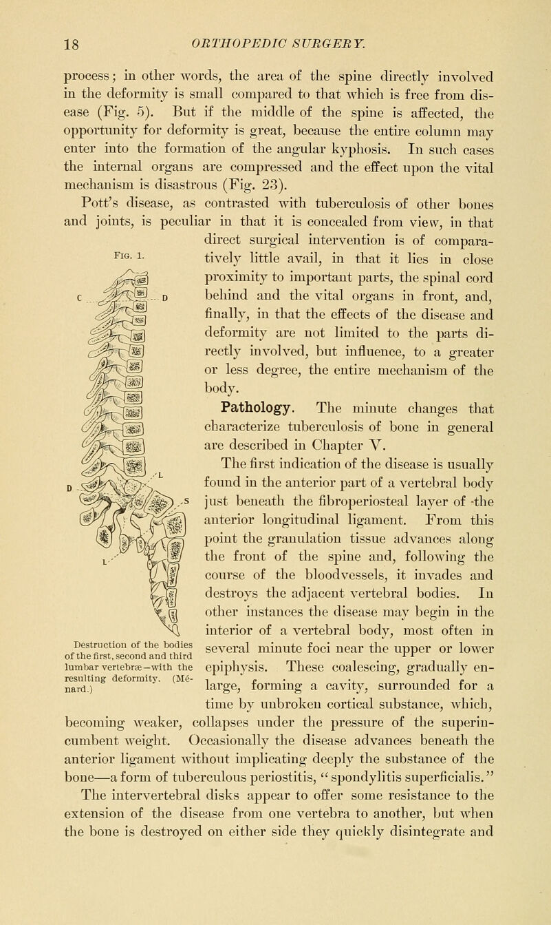 Fig. 1. process; in other words, the area of the spine directly involved in the deformity is small compared to that which is free from dis- ease (Fig. 5). But if the middle of the spine is affected, the opportunity for deformity is great, because the entire column may enter into the formation of the angular kyphosis. In such cases the internal organs are compressed and the effect upon the vital mechanism is disastrous (Fig. 23). Pott's disease, as contrasted with tuberculosis of other bones and joints, is peculiar in that it is concealed from view, in that direct surgical intervention is of compara- tively little avail, in that it lies in close proximity to important parts, the spinal cord behind and the vital organs in front, and, finally, in that the effects of the disease and deformity are not limited to the parts di- rectly involved, but influence, to a greater or less degree, the entire mechanism of the body. Pathology. The minute changes that characterize tuberculosis of bone in general are described in Chapter V. The first indication of the disease is usually found in the anterior part of a vertebral body just beneath the fibroperiosteal layer of -the anterior longitudinal ligament. From this point the granulation tissue advances along the front of the spine and, following the course of the bloodvessels, it invades and destroys the adjacent vertebral bodies. In other instances the disease may begin in the interior of a vertebral body, most often in several minute foci near the upper or lower epiphysis. These coalescing, gradually en- large, forming a cavity, surrounded for a time by unbroken cortical substance, which, becoming weaker, collapses under the pressure of the superin- cumbent weight. Occasionally the disease advances beneath the anterior ligament without implicating deeply the substance of the bone—a form of tuberculous periostitis,  spondylitis superficialis. The intervertebral disks appear to offer some resistance to the extension of the disease from one vertebra to another, but when the bone is destroyed on either side they quickly disintegrate and Destruction of the bodies of the first, second and third lumbar vertebrse—with the resulting deformity. (Me- nard.)