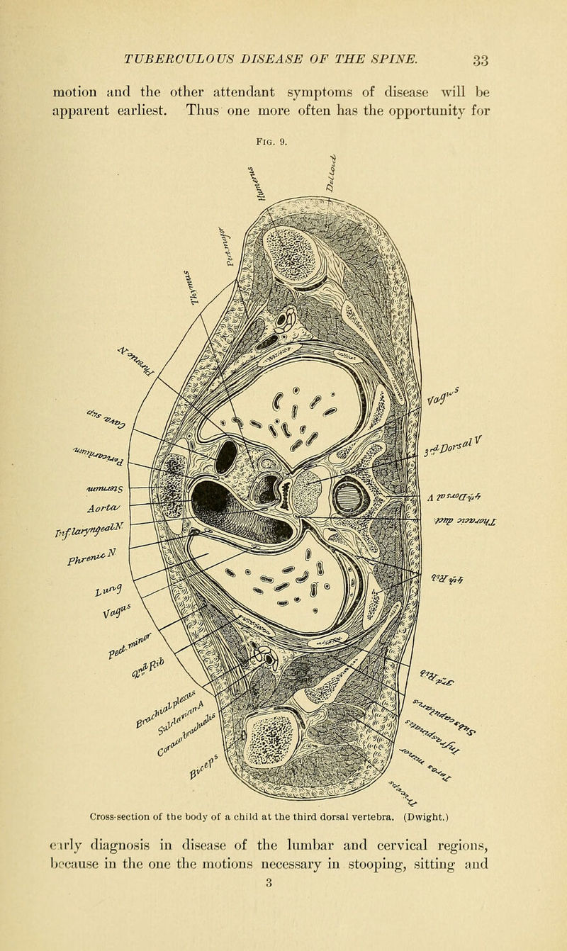 motion and the other attendant symptoms of disease will be apparent earliest. Thus one more often has the opportunity for Fig. 9. 5!. '^■^, Aortcu phrer^ <ry Cross-section of the body of a child at the third dorsal vertebra. (Dwight.) eirly diagnosis in disease of the lumbar and cervical regions, because in the one the motions necessary in stooping, sitting and 3