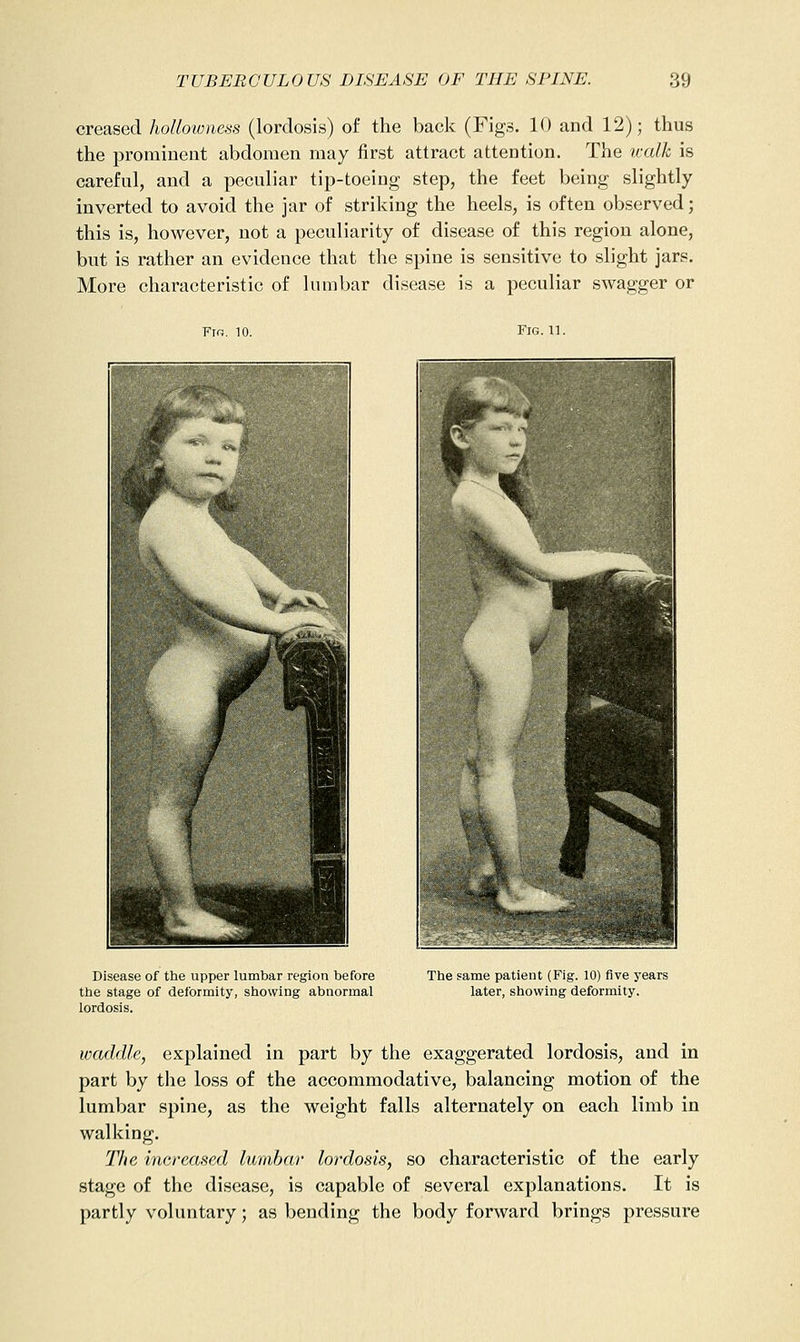 creased hollovmess (lordosis) of the back (Figs. 10 and 12); thus the prominent abdomen may first attract attention. The walk is careful, and a peculiar tip-toeing step, the feet being slightly inverted to avoid the jar of striking the heels, is often observed; this is, however, not a peculiarity of disease of this region alone, but is rather an evidence that the spine is sensitive to slight jars. More characteristic of lumbar disease is a peculiar swagger or Fm. 10. Fig. 11. Disease of the upper lumbar region before the stage of deformity, showing abnormal lordosis. The same patient (Fig. 10) five years later, showing deformity. waddle, explained in part by the exaggerated lordosis, and in part by the loss of the accommodative, balancing motion of the lumbar spine, as the weight falls alternately on each limb in walking. The increased lumbar lordosis, so characteristic of the early stage of the disease, is capable of several explanations. It is partly voluntary; as bending the body forward brings pressure
