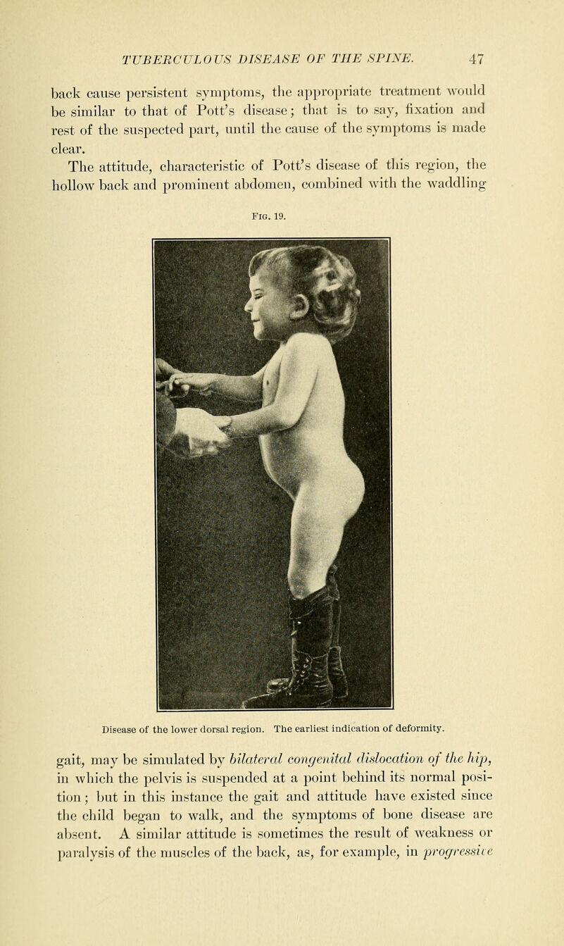 back cause persistent symptoms, the appropriate treatment would be similar to that of Pott's disease; that is to say, fixation and rest of the suspected part, until the cause of the symptoms is made clear. The attitude, characteristic of Pott's disease of this region, the hollow back and prominent abdomen, combined with the waddling Fig. 19. Disease of the lower dorsal region. The earliest indication of deformity. gait, may be simulated by bilateral congenital dislocation of the hip, in which the pelvis is suspended at a point behind its normal posi- tion ; l)ut in this instance the gait and attitude have existed since the cliild began to walk, and the symptoms of bone disease are absent. A similar attitude is sometimes the result of weakness or ])aralysis of tin; muscles of the back, as, for example, in progressive