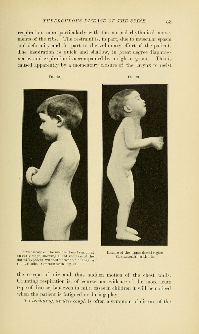 respiration, more particularly with the normal rhythmical move- ments of the ribs. The restraint is, in part, due to muscular spasm and deformity and in part to the voluntary effort of the patient. The inspiration is quick and shallow, in great degree diaphrag- matic, and expiration is accompanied by a sigh or grunt. This is caused apparently by a momentary closure of the larynx to resist Fig. 20. Fig. 21. Pott's disease of the middle dorsal region at an early stage, showing slight increase of the dorsal kyphosis, without noticeable change in the attitude. Contrast with Fig. 21. Disease of the upper dorsal region. Characteristic attitude. the escape of air and thus sudden motion of the chest walls. Grunting respiration is, of course, an evidence of the more acute type of disease, but even in mild cases in children it will be noticed when th(i patient is fatigued or during play. An irritating, aim/ess cough is often a symptom of disease of the