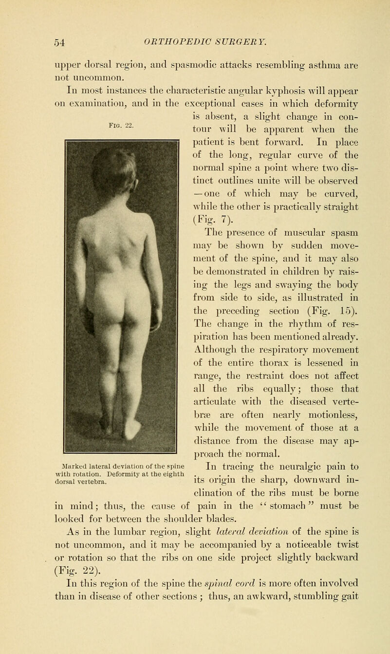 Fig. 22. upper dorsal region, and spasmodic attacks resembling asthma are not uncommon. In most instances the characteristic angular kyphosis will appear on examination, and in the exceptional cases in which deformity is absent, a slight change in con- tour will be apparent when the patient is bent forward. In place of the long, regular curve of the normal spine a point where two dis- tinct outlines unite will be observed — one of which may be curved, while the other is practically straight (Fig. 7). The presence of muscular spasm may be shown by sudden move- ment of the spine, and it may also be demonstrated in children by rais- ing the legs and swaying the body from side to side, as illustrated in the preceding section (Fig. 15). The change in the rhytlim of res- piration has been mentioned already. A.lthough the respiratory movement of the entire thorax is lessened in range, the restraint does not affect all the ribs equally; those that articulate with the diseased verte- brae are often nearly motionless, while the movement of those at a distance from the disease may ap- proach the normal. In tracing the neuralgic j^ain to its origin the sharp, downward in- clination of the ribs must be borne pain in the '' stomach  must be Marked lateral deviation of the spine with rotation. Deformity at the eighth dorsal vertebra. in mind; thus, the cause of looked for between the shoulder blades. As in the lumbar region, slight lateral deviation of the spine is not uncommon, and it may be accompanied by a noticeable twist or rotation so that the ribs on one side project slightly backward (Fig. 22). In this region of the spine the spinal cord is more often involved than in disease of other sections ; thus, an awkward, stumbling gait