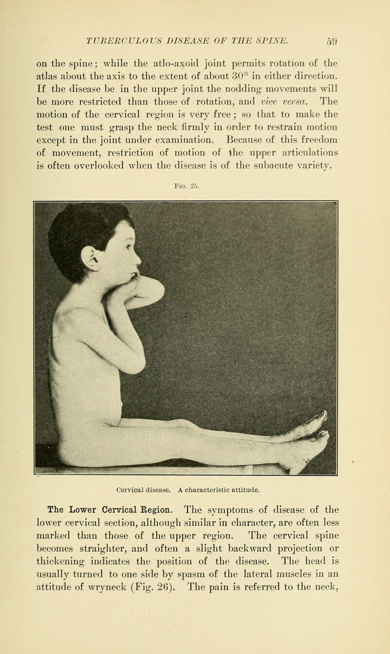 on the spine; while the atlo-axoid joint permits rotation of the atlas about the axis to the extent of about 30° in either direction. If the disease be in the upper joint the nodding movements will be more restricted than those of rotation, and viee versa. The motion of the cervical region is very free ; so that to make the test one must grasp the neck firmly in order to restrain motion except in the joint under examination. Because of this freedom of movement, restriction of motion of the upper articulations is often overlooked when the disease is of the subacute variety. Fig. 25. Cervical disease. A characteristic attitude. The Lower Cervical Region. The symptoms of disease of the lower cervical section, although similar in character, are often less marked than those of the upper region. The cervical spine becomes straighter, and often a slight backward projection or thickening indicates the position of the disease. The head is usually turned to one side by spasm of the lateral muscles in an attitude of wryneck (Fig. 26). The pain is referred to the neck,