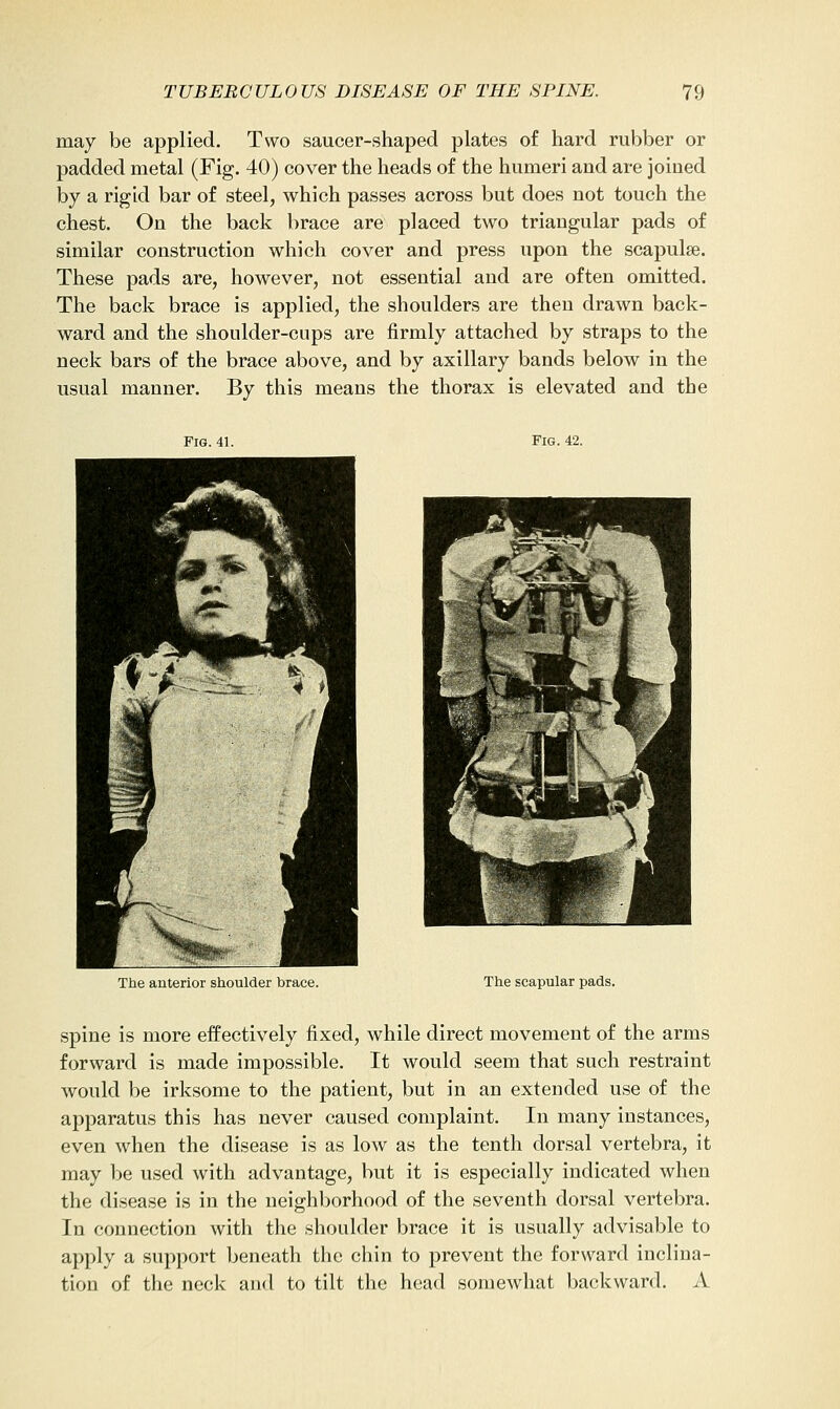 may be applied. Two saucer-shaped plates of hard rubber or padded metal (Fig. 40) cover the heads of the humeri and are joined by a rigid bar of steel, which passes across but does not touch the chest. On the back brace are placed two triangular pads of similar construction which cover and press upon the scapulae. These pads are, however, not essential and are often omitted. The back brace is applied, the shoulders are then drawn back- ward and the shoulder-cups are firmly attached by straps to the neck bars of the brace above, and by axillary bands below in the usual manner. By this means the thorax is elevated and the Fig. 41. Fig. 42. The anterior shoulder brace. The scapular pads. spine is more effectively fixed, while direct movement of the arms forward is made impossible. It would seem that such restraint would be irksome to the patient, but in an extended use of the apparatus this has never caused complaint. In many instances, even when the disease is as low as the tenth dorsal vertebra, it may be used with advantage, but it is especially indicated when the disease is in the neighborhood of the seventh dorsal vertebra. In connection with the shoulder brace it is usually advisable to apply a support beneath the chin to prevent the forward inclina- tion of the neck and to tilt the head somewhat backward. A