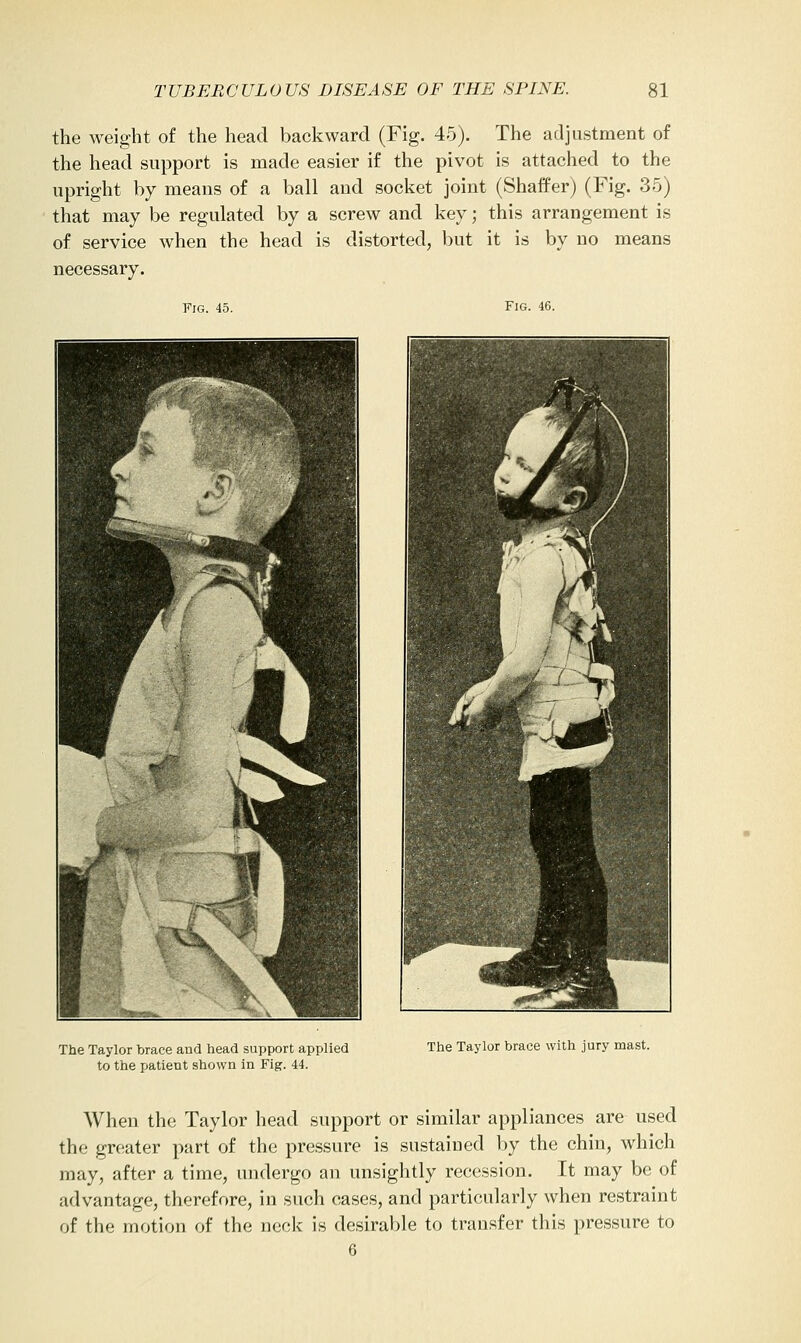 the weight of the head backward (Fig. 45). The adjustment of the head support is made easier if the pivot is attached to the upright by means of a ball and socket joint (Shaffer) (Fig. 35) that may be regulated by a screw and key; this arrangement is of service when the head is distorted, but it is by no means necessary. Fig. 46. The Taylor brace and head support applied to the patient shown in Fig. 44. The Taylor brace with jury mast. When the Taylor head support or similar appliances are used the greater part of the pressure is sustained by the chin, which may, after a time, undergo an unsightly recession. It may be of advantage, therefore, in such cases, and particularly when restraint of the motion of the neck is desirable to transfer this pressure to 6