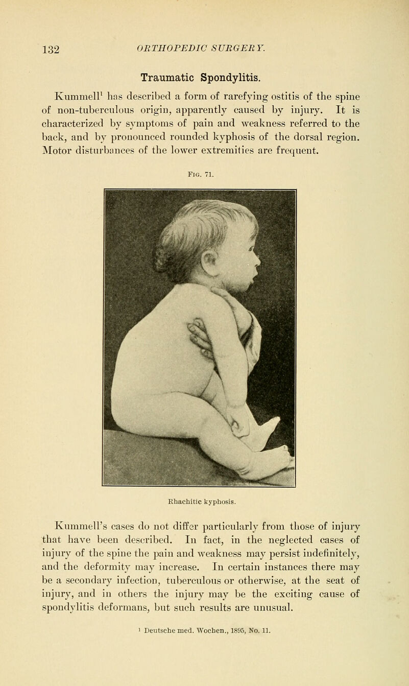 Traumatic Spondylitis. KummelP has described a form of rarefying ostitis of the spine of non-tuberculous origin, apparently caused by injury. It is characterized by symptoms of pain and weakness referred to the back, and by pronounced rounded kyphosis of the dorsal region. Motor disturbances of the lower extremities are frequent. Fig. 71. Khachitic kyphosis. Kummell's cases do not differ particularly from those of injury that have been described. In fact, in the neglected cases of injury of the spine the pain and weakness may persist indefinitely, and the deformity may increase. In certain instances there may be a secondary infection, tuberculous or otherwise, at the seat of injury, and in others the injury may be the exciting cause of spondylitis deformans, but such results are unusual. 1 Deutsche med. Wochen., 1895, No. 11.