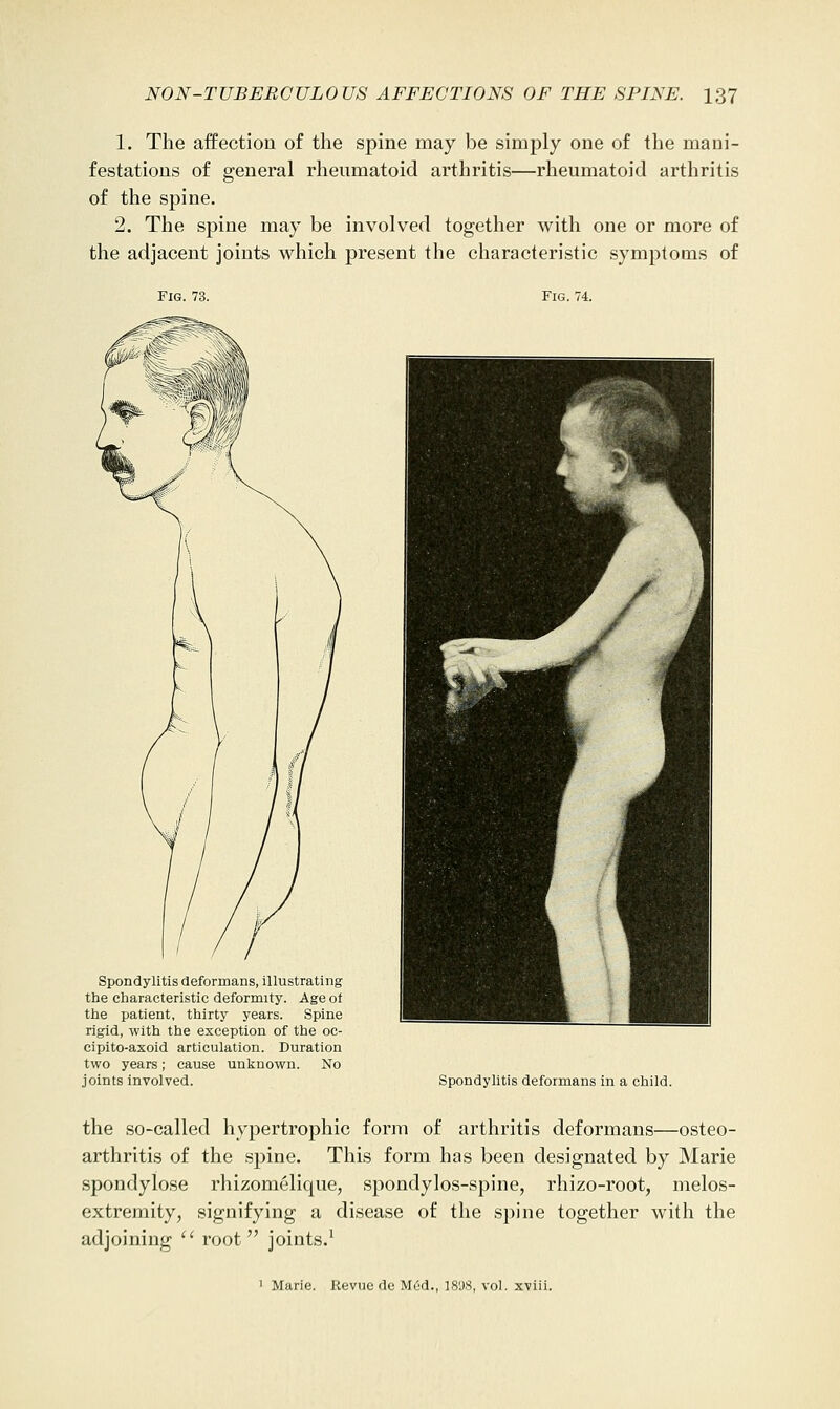 1. The affection of the spine may be simply one of the mani- festations of general rheumatoid arthritis—rheumatoid arthritis of the spine. 2. The spine may be involved together with one or more of the adjacent joints which present the characteristic symptoms of Fig. 73. Fig. 74. Spondylitis deformans, illustrating the characteristic deformity. Age of the patient, thirty years. Spine rigid, with the exception of the oc- cipito-axoid articulation. Duration two years; cause unknown. No joints involved. Spondylitis deformans in a child. the so-called hypertrophic form of arthritis deformans—osteo- arthritis of the spine. This form has been designated by Marie spondylose rhizomelique, spondylos-spine, rhizo-root, melos- extremity, signifying a disease of the spine together with the adjoining • root joints.^ 1 Marie. Revue dc M6d., 18'.)8, vol. xviii