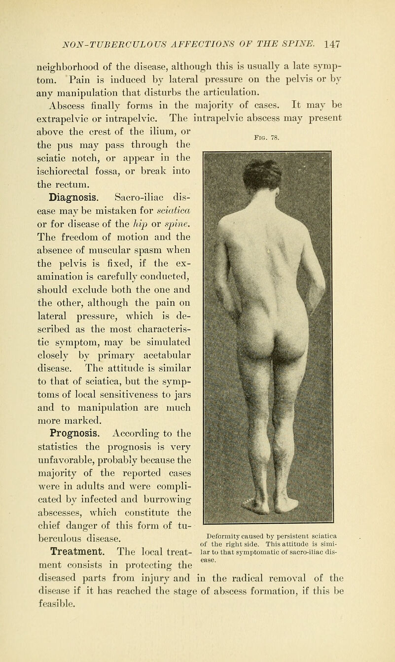 Fig. 78. neighborhood of the disease, although this is usually a late symp- tom. Pain is induced by lateral pressure on the pelvis or by any manipulation that disturbs the articulation. Abscess finally forms in the majority of cases. It may be extrapelvic or intrapelvic. The intrapelvic abscess may present above the crest of the ilium, or the pus may pass through the sciatic notch, or appear in the ischiorectal fossa, or break into the rectum. Diagnosis. Sacro-iliac dis- ease may be mistaken for sciatica or for disease of the hvp or spine. The freedom of motion and the absence of muscular spasm when the pelvis is fixed, if the ex- amination is carefully conducted, should exclude both the one and the other, although the pain on lateral pressure, which is de- scribed as the most characteris- tic symptom, may be simulated closely by primary acetabular disease. The attitude is similar to that of sciatica, but the symp- toms of local sensitiveness to jars and to manipulation are much more marked. Prognosis. According to the statistics the prognosis is very unfavorable, probably because the majority of the reported cases were in adults and were compli- cated by infected and burrowing abscesses, which constitute the chief danger of this form of tu- berculous disease. Treatment. Tlie local treat- ment consists in protecting the diseased parts from injury and in the radical removal of the disease if it has reached the stage of abscess formation, if this be feasible. Deformity caused by persistent sciatica of the right side. This attitude is simi- lar to that symptomatic of sacro-iliac dis- ease.