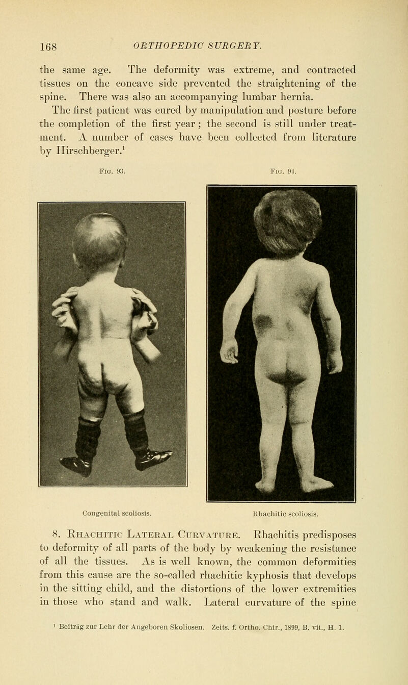 the same age. The deformity was extreme, and contracted tissues on the concave side prevented the straightening of the spine. There Avas also an accompanying lumbar hernia. The first patient was cured by manipulation and posture before the completion of the first year; the second is still under treat- ment. A number of cases have been collected from literature by Hirschberger.^ Fig. 93. Fig. 94. Congenital scoliosis. Khachitic scoliosis. 8. Rhachitic Lateral Curvature. Rhachitis predisposes to deformity of all parts of the body by weakening the resistance of all the tissues. As is well known, the common deformities from this cause are the so-called rhachitic kyphosis that develops in the sitting child, and the distortions of the lower extremities in those who stand and walk. Lateral curvature of the spine 1 Beitriig zur Lehr der Angeboren Skoliosen. Zeits. f. Ortho. Chir., 1899, B. vii., H. 1.