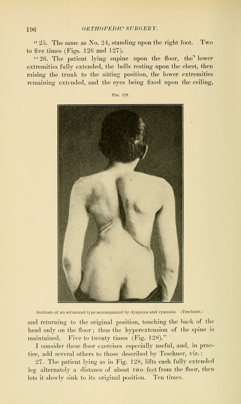  25. The same as No. 24, standing upon the right foot. Two to five times (Figs. 126 and 127). ''26. The patient lying supine upon the floor, the^ lower extremities fully extended, the bells resting upon the chest, then raising the trunk to the sitting position, the lower extremities remaining extended, and the eyes being fixed upon the ceiling, Pig. ]29. Scoliosis of an advanced type accompanied by dyspnoea and cyanosis. (Teschner.) and returning to the original position, touching the back of the head only on the floor; thus the hyperextension of the spine is maintained. Five to twenty times (Fig. 128). I consider these floor exercises especially useful, and, in prac- tice, add several others to those described by Teschner, viz.: 27. The patient lying as in Fig. 128, lifts each fully extended leg alternately a distance of about two feet from the floor, then lets it slowly sink to its original position. Ten times.