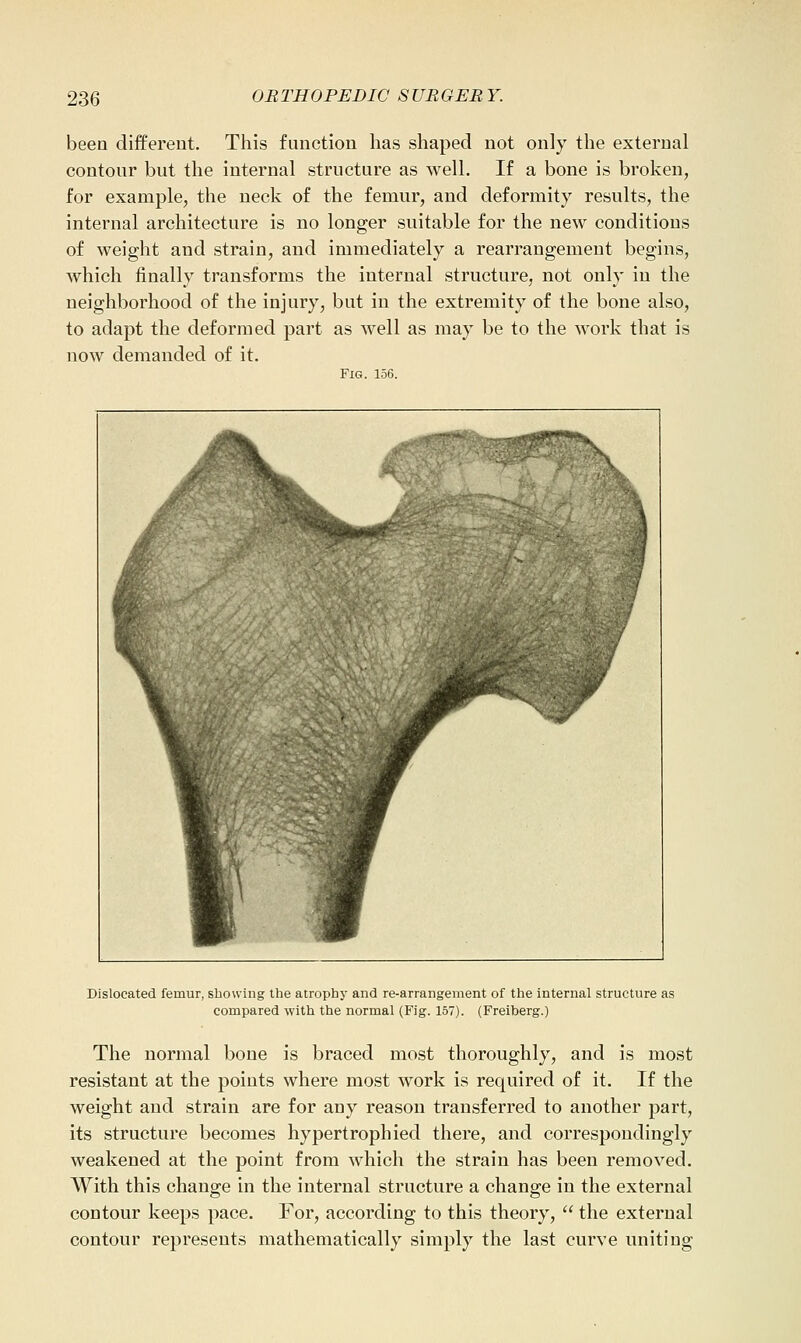 been different. This function has shaped not only the external contour but the internal structure as well. If a bone is broken, for example, the neck of the femur, and deformity results, the internal architecture is no longer suitable for the new conditions of weight and strain, and immediately a rearrangement begins, which finally transforms the internal structure, not only in the neighborhood of the injury, but in the extremity of the bone also, to adapt the deformed part as well as may be to the work that is now demanded of it. Fig. 156. Dislocated femur, showing the atrophy and re-arrangement of the internal structure as compared with the normal (Fig. 157). (Freiberg.) The normal bone is braced most thoroughly, and is most resistant at the points where most work is required of it. If the weight and strain are for any reason transferred to another part, its structure becomes hypertrophied there, and correspondingly weakened at the point from which the strain has been removed. With this change in the internal structure a change in the external contour keeps pace. For, according to this theory,  the external contour represents mathematically simply the last curve uniting