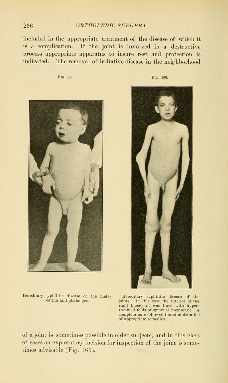 included in the appropriate treatment of the disease of which it is a complication. If the joint is involved in a destructive process appropriate apparatus to insure rest and protection is indicated. The removal of irritative disease in the neighborhood Fig. 165. Fig. 166. Hereditary syphilitic disease of the meta- carpus and phalanges. Hereditary syphilitic disease of the joints. In this case the interior of the right knee-joint was lined with hyper- trophied folds of synovial membrane. A complete cure followed the administration of appropriate remedies. of a joint is sometimes possible in older subjects, and in this class of cases an exploratory incision for inspection of the joint is some- times advisable (Fig. 166).