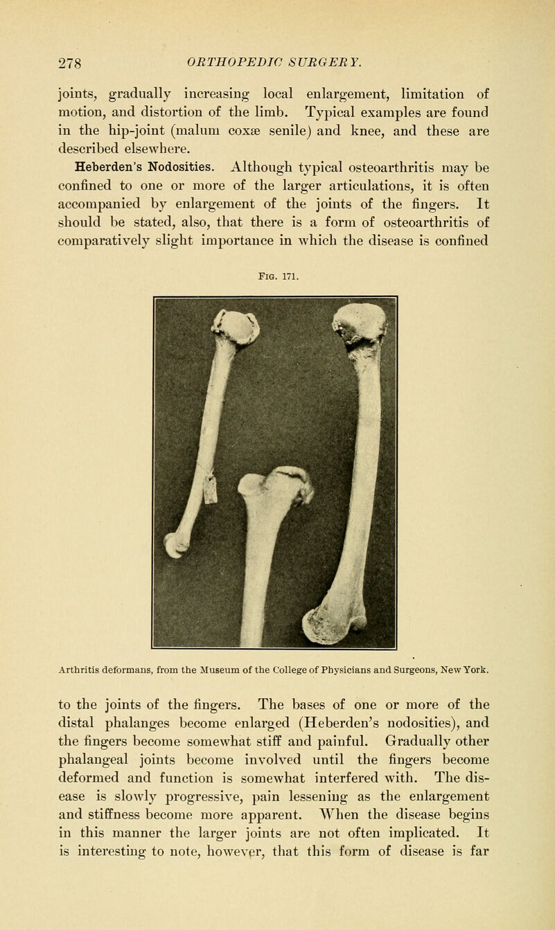 joints, gradually increasing local enlargement, limitation of motion, and distortion of the limb. Typical examples are found in the hip-joint (malum coxse senile) and knee, and these are described elsewhere. Heberden's Nodosities. Although typical osteoarthritis may be confined to one or more of the larger articulations, it is often accompanied by enlargement of the joints of the fingers. It should be stated, also, that there is a form of osteoarthritis of comparatively slight importance in which the disease is confined Fig. 171. Arthritis deformans, from the Museum of the College of Physicians and Surgeons, New York. to the joints of the fingers. The bases of one or more of the distal phalanges become enlarged (Heberden's nodosities), and the fingers become somewhat stiff and painful. Gradually other phalangeal joints become involved until the fingers become deformed and function is somewhat interfered with. The dis- ease is slowly progressive, pain lessening as the enlargement and stiffness become more apparent. When the disease begins in this manner the larger joints are not often implicated. It is interesting to note, however, that this form of disease is far