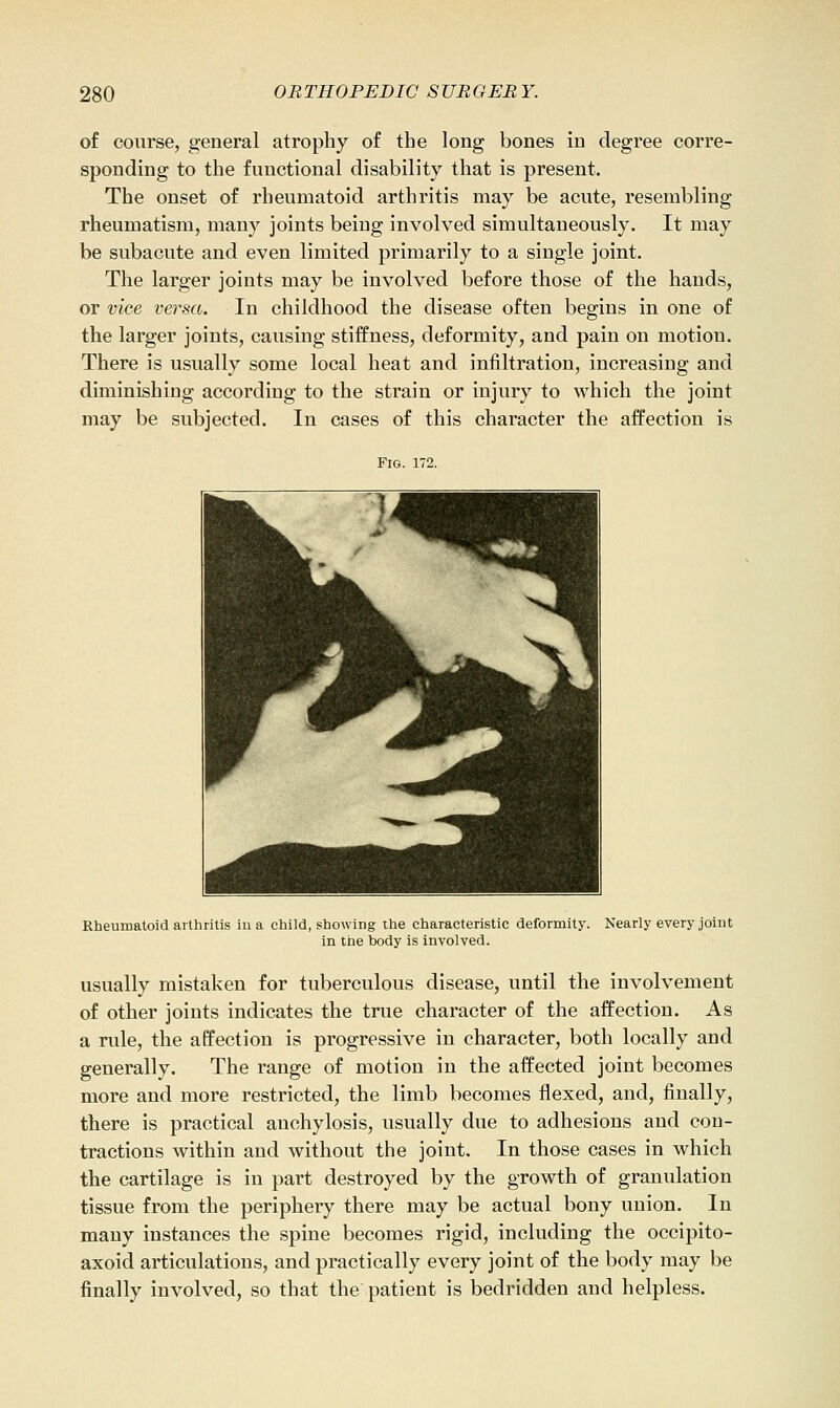 of course, general atrophy of the long bones in degree corre- sponding to the functional disability that is present. The onset of rheumatoid arthritis may be acute, resembling rheumatism, many joints being involved simultaneously. It may be subacute and even limited primarily to a single joint. The larger joints may be involved before those of the hands, or vice versa. In childhood the disease often begins in one of the larger joints, causing stiffness, deformity, and pain on motion. There is usually some local heat and infiltration, increasing and diminishing according to the strain or injury to which the joint may be subjected. In cases of this character the affection is Fig. 172. Rheumatoid arthritis in a child, showing the characteristic deformity. Nearly every joint in the body is Involved. usually mistaken for tuberculous disease, until the involvement of other joints indicates the true character of the affection. As a rule, the affection is progressive in character, both locally and generally. The range of motion in the affected joint becomes more and more restricted, the limb becomes flexed, and, finally, there is practical anchylosis, usually due to adhesions and con- tractions within and without the joint. In those cases in which the cartilage is in part destroyed by the growth of granulation tissue from the periphery there may be actual bony union. In many instances the spine becomes rigid, including the occipito- axoid articulations, and practically every joint of the body may be finally involved, so that the patient is bedridden and helpless.