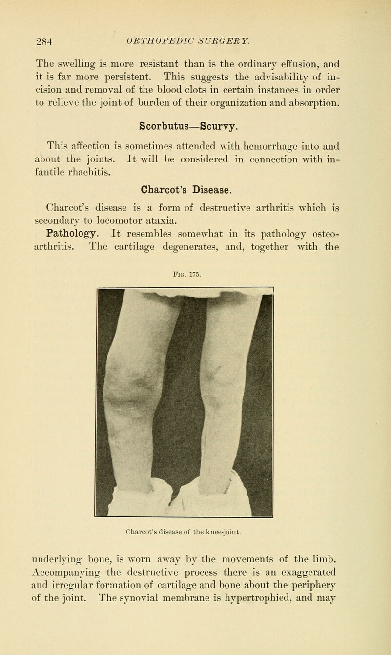 The swelling is more resistant than is the ordinary effusion, and it is far more persistent. This suggests the advisability of in- cision and removal of the blood clots in certain instances in order to relieve the joint of burden of their organization and absorption. Scorbutus—Scurvy. This affection is sometimes attended with hemorrhage into and about the joints. It will be considered in connection with in- fantile rhachitis. Charcot's Disease. Charcot's disease is a form of destructive arthritis which is secondary to locomotor ataxia. Pathology. It resembles somewhat in its pathology osteo- arthritis. The cartilage degenerates, and, together with the Fig. 175. Charcot's disease of the knee-joiat. underlying bone, is worn away by the movements of the limb. Accompanying the destructive process there is an exaggerated and irregular formation of cartilage and bone about the periphery of the joint. The synovial membrane is hypertrophied, and may