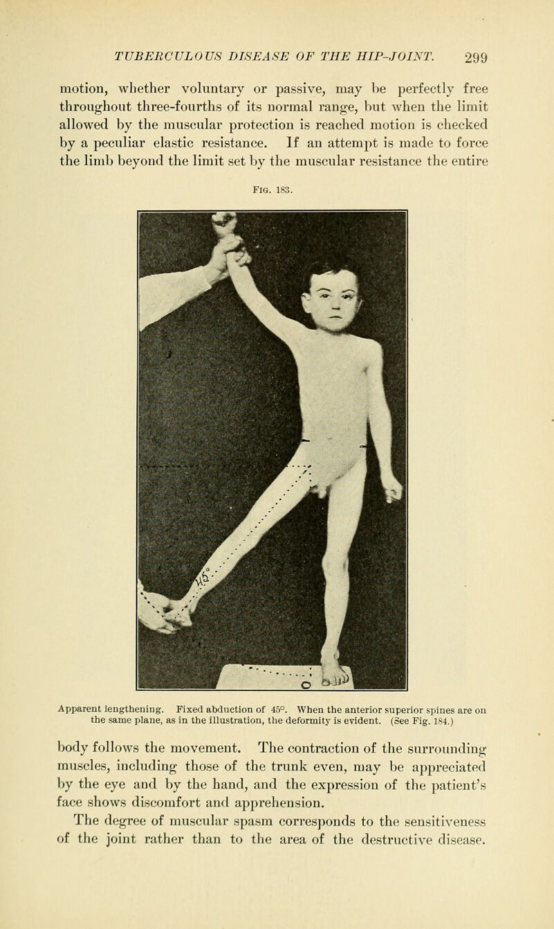 motion, whether voluntary or passive, may be perfectly free throughout three-fourths of its normal range, but when the limit allowed by the muscular protection is reached motion is checked by a peculiar elastic resistance. If an attempt is made to force the limb beyond the limit set by the muscular resistance the entire Fig. 183. Apparent lengthening. Fixed abduction of 45°. When the anterior superior spines are on the same plane, as in the illustration, the deformity is evident. (See Fig. 184.) body follows the movement. The contraction of the surrounding muscles, including those of the trunk even, may be appreciated by the eye and by the hand, and the expression of the patient's face shows discomfort and apprehension. The degree of muscular spasm corresponds to the sensitiveness of the joint rather than to the area of the destructive disease.