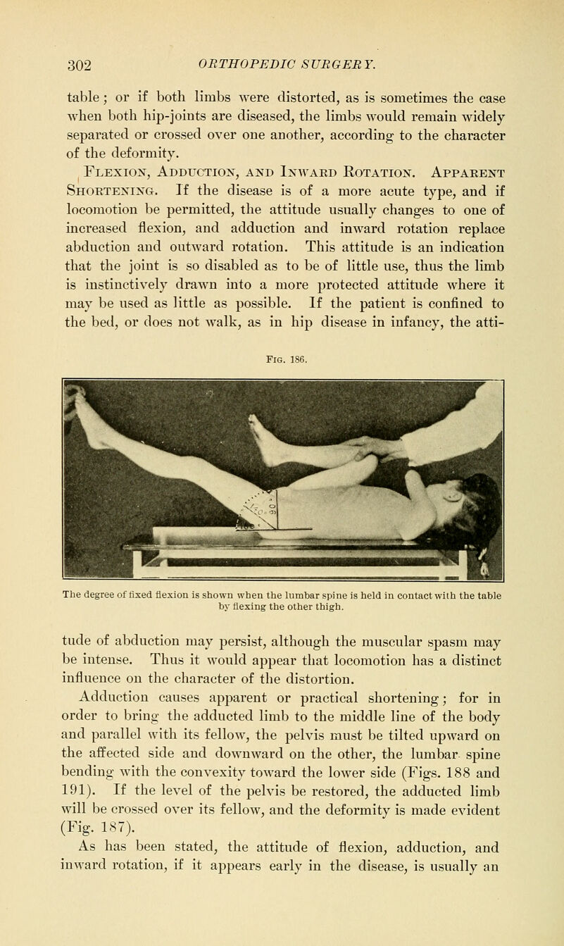 table; or if both limbs were distorted, as is sometimes the case when both hip-joints are diseased, the limbs would remain widely separated or crossed over one another, according to the character of the deformity. Flexion, Adduction, and Inward Eotation. Apparent Shortening. If the disease is of a more acute type, and if locomotion be permitted, the attitude usually changes to one of increased flexion, and adduction and inward rotation replace abduction and outward rotation. This attitude is an indication that the joint is so disabled as to be of little use, thus the limb is instinctively drawn into a more protected attitude where it may be used as little as possible. If the patient is confined to the bed, or does not walk, as in hip disease in infancy, the atti- FiG. 186. The degree of fixed flexion is shown when the lumbar spine is held in contact with the table by flexing the other thigh. tude of abduction may persist, although the muscular spasm may be intense. Thus it would appear that locomotion has a distinct influence on the character of the distortion. Adduction causes apparent or practical shortening; for in order to bring the adducted limb to the middle line of the body and parallel with its fellow, the pelvis must be tilted upward on the affected side and downward on the other, the lumbar spine bending with the convexity toward the lower side (Figs. 188 and 191). If the level of the pelvis be restored, the adducted limb will be crossed over its fellow, and the deformity is made evident (Fig. 187). As has been stated, the attitude of flexion, adduction, and inward rotation, if it appears early in the disease, is usually an