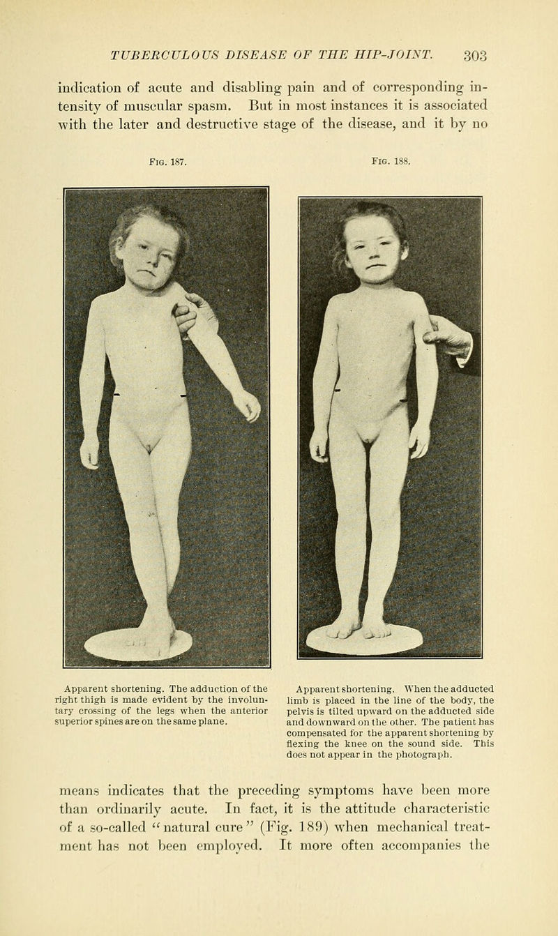 indication of acute and disabling pain and of corresponding in- tensity of muscular spasm. But in most instances it is associated with the later and destructive stage of the disease, and it by no Fig. 187. Fig. 188. Apparent shortening. The adduction of the right thigh is made evident by the involun- tary crossing of the legs when the anterior superior spines are on the same plane. Apparent shortening. When the adducted limb is placed in the line of the body, the pelvis is tilted upward on the adducted side and downward on the other. The patient has compensated for the apparent shortening by flexing the knee on the sound side. This does not appear in the photograph. means indicates that the preceding symptoms have been more than ordinarily acute. In fact, it is the attitude characteristic of a so-called natural cure (Fig. 189) when mechanical treat- ment has not been employed. It more often accompanies the