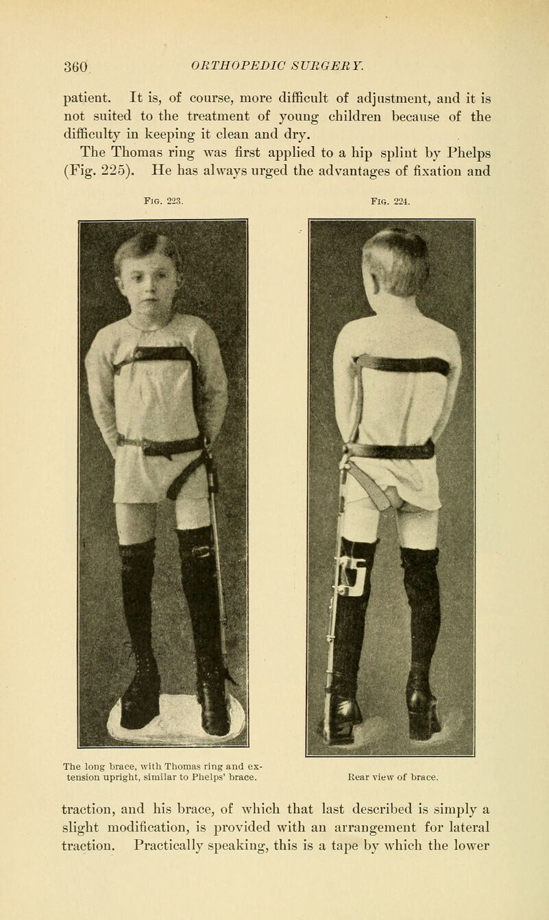 patient. It is, of course, more difficult of adjustment, and it is not suited to the treatment of young children because of the difficulty in keeping it clean and dry. The Thomas ring was first applied to a hip splint by Phelps (Fig. 225). He has always urged the advantages of fixation and Fig. 223. Fig. 224. The long brace, with Thomas ring and ex- tension upright, similar to Phelps' brace. Rear view of brace. traction, and his brace, of which that last described is simply a slight modification, is provided with an arrangement for lateral traction. Practically speaking, this is a tape by which the lower