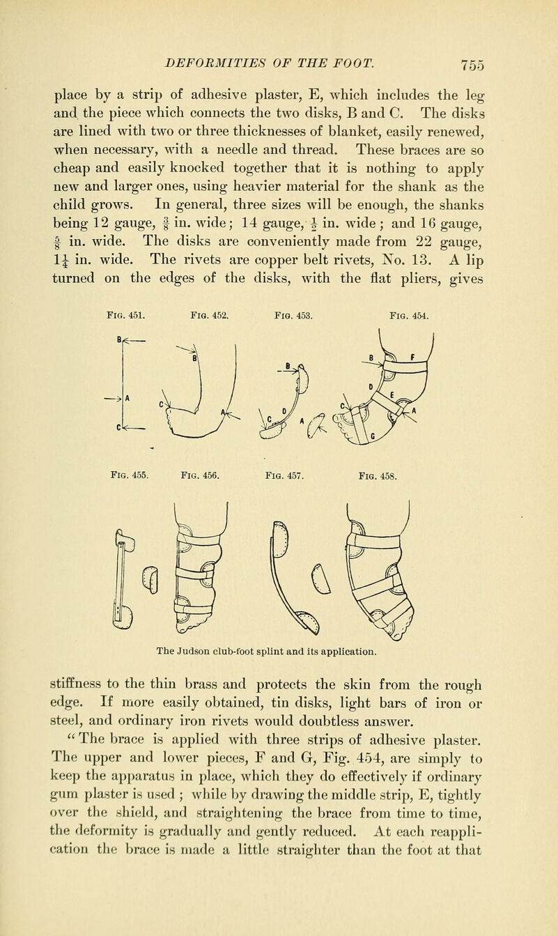 place by a strip of adhesive plaster, E, which includes the leg and the piece which connects the two disks, B and C. The disks are lined with two or three thicknesses of blanket, easily renewed, when necessary, with a needle and thread. These braces are so cheap and easily knocked together that it is nothing to apply new and larger ones, using heavier material for the shank as the child grows. In general, three sizes will be enough, the shanks being 12 gauge, f in. wide; 14 gauge, i in. wide ; and 16 gauge, I in. wide. The disks are conveniently made from 22 gauge, \\ in. wide. The rivets are copper belt rivets, No. 13. A lip turned on the edges of the disks, with the flat pliers, gives Fig. 453. Fig. 454. Fig. 455. Fig. 456. Fig. 457. Fig. 458. The Judson club-foot splint and its application. stiffness to the thin brass and protects the skin from the rough edge. If more easily obtained, tin disks, light bars of iron or steel, and ordinary iron rivets would doubtless answer.  The brace is applied with three strips of adhesive plaster. The upper and lower pieces, F and G, Fig. 454, are simply to keep the apparatus in place, which they do effectively if ordinary gum plaster i.s used ; while by drawing the middle strip, E, tightly over the shield, and straightening the brace from time to time, the deformity is gradually and gently reduced. At each reappli- cation the brace is made a little straighter than the foot at that