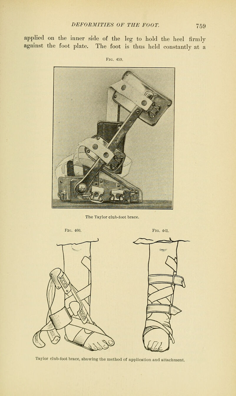 applied on the inner side of the leg to hold the heel firmly against the foot plate. The foot is thus held constantly at a Fig. 459. The Taylor club-foot brace. Fig. 460. Fig. 4*51. Taylor club-foot brace, showing the method of application and attachment.