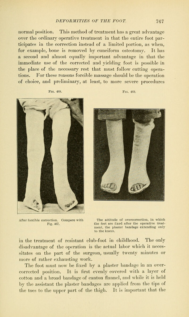 normal position. This method of treatment has a great advantage over the ordinary operative treatment in that the entire foot par- ticipates in the correction instead of a limited portion, as when, for example, bone is removed by cuneiform osteotomy. It has a second and almost equally important advantage in that the immediate use of the corrected and yieldiug foot is possible in the place of the necessary rest that must follow cutting opera- tions. For these reasons forcible massage should be the operation of choice, and preliminary, at least, to more severe procedures Fig. 469. After forcible correction. Compare with Fig. 467. The attitude of overcorrectiou, in which the feet are fixed after the operative treat- ment, the plaster bandage extending only to the knees. in the treatment of resistant club-foot in childhood. The only disadvantage of the operation is the actual labor which it neces- sitates on the part of the surgeon, usually twenty minutes or more of rather exhausting work. The foot must now be fixed by a plaster bandage in an over- corrected position. It is first evenly covered with a layer of cotton and a broad bandage of canton flannel, and while it is held by the assistant the plaster bandages are ai)plicd from the tips of the toes to the upper part of the thigh. It is important that the