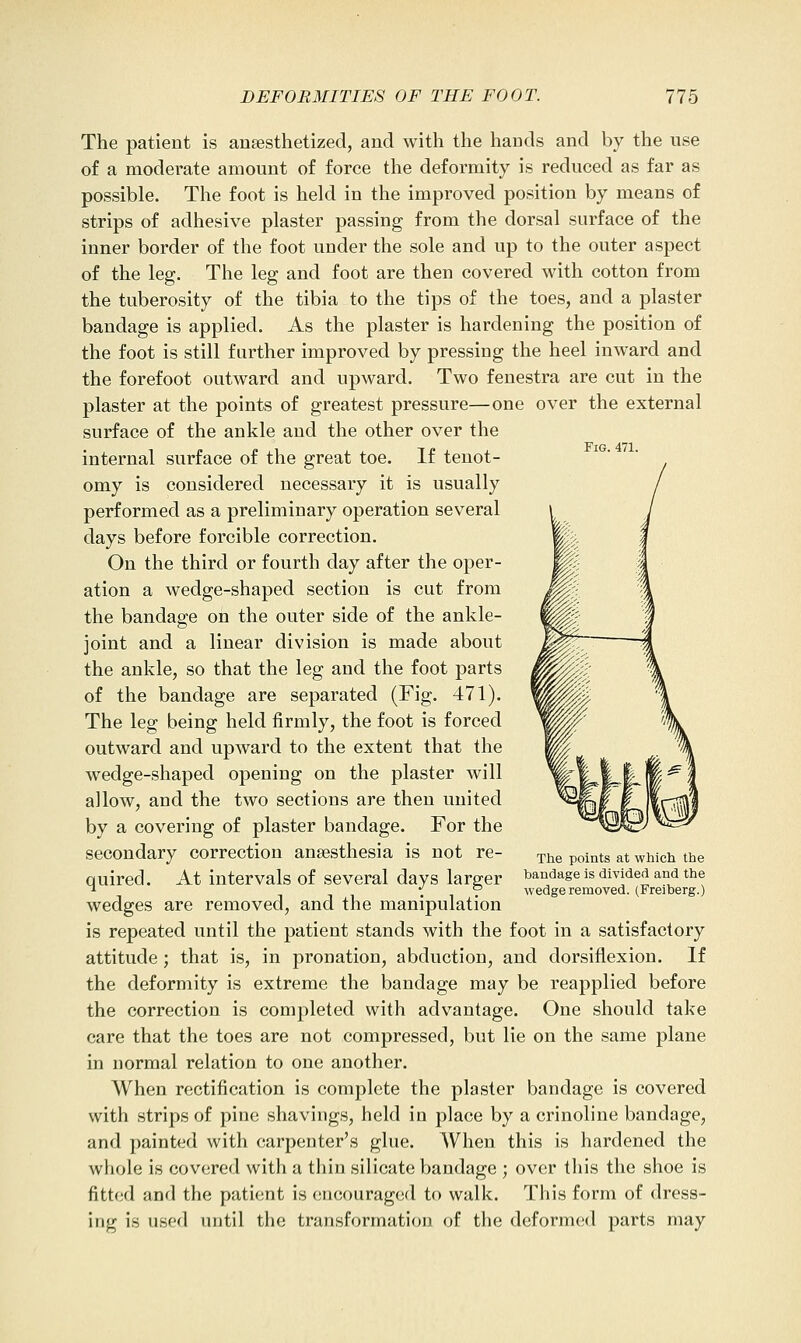 Fig. 471. The patient is anaesthetized, and with the hands and by the use of a moderate amount of force the deformity is reduced as far as possible. The foot is held in the improved position by means of strips of adhesive plaster passing from the dorsal surface of the inner border of the foot under the sole and up to the outer aspect of the leg. The leg and foot are then covered with cotton from the tuberosity of the tibia to the tips of the toes, and a plaster bandage is applied. As the plaster is hardening the position of the foot is still farther improved by pressing the heel inward and the forefoot outward and upward. Two fenestra are cut in the plaster at the points of greatest pressure—one over the external surface of the ankle and the other over the internal surface of the great toe. If tenot- omy is considered necessary it is usually performed as a preliminary operation several days before forcible correction. On the third or fourth day after the oper- ation a wedge-shaped section is cut from the bandage on the outer side of the ankle- joint and a linear division is made about the ankle, so that the leg and the foot parts of the bandage are separated (Fig. 471). The leg being held firmly, the foot is forced outward and upward to the extent that the wedge-shaped opening on the plaster will allow, and the two sections are then united by a covering of plaster bandage. For the secondary correction anaesthesia is not re- quired. At intervals of several days larger wedges are removed, and the manipulation is repeated until the patient stands with the foot in a satisfactory attitude; that is, in pronation, abduction, and dorsiflexion. If the deformity is extreme the bandage may be reapplied before the correction is completed with advantage. One should take care that the toes are not compressed, but lie on the same plane in normal relation to one another. When rectification is complete the plaster bandage is covered with strips of pine shavings, held in place by a crinoline bandage, and painted with carpenter's glue. When this is hardened the whole is covered with a thin silicate bandage ; over this the shoe is fitt<;d and the patient is (jucouragcd to walk. This form of dress- ing is used until the transformation of the deformed parts may The points at which the bandage is divided and the wedge removed. (Freiberg.)