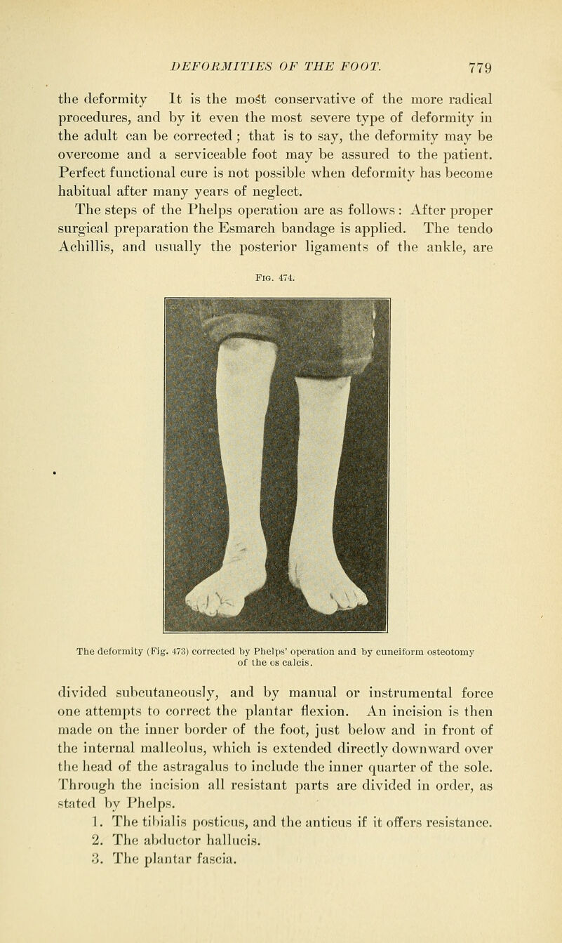 the deformity It is the mo^t conservative of the more radical procedures, and by it even the most severe type of deformity in the adult can be corrected; that is to say, the deformity may be overcome and a serviceable foot may be assured to the patient. Perfect functional cure is not possible when deformity has become habitual after many years of neglect. The steps of the Phelps operation are as follows : After proper surgical preparation the Esmarch bandage is applied. The tendo Achillis, and usually the posterior ligaments of the ankle, are The deformity (Fig. 473) corrected by Phelps' operation and by cuneiform osteotomy of the OS calcis. divided subcutaneously, and by manual or instrumental force one attempts to correct the plantar flexion. An incision is then made on the inner border of the foot, just below and in front of the internal malleolus, which is extended directly downward over the head of the astragalus to include the inner quarter of the sole. Through the incision all resistant parts are divided in order, as stated by Phelps. 1. Tlie tibialis posticus, and the anticus if it offers resistance. 2. The abchictor hallucis. 3. The plantar fascia.