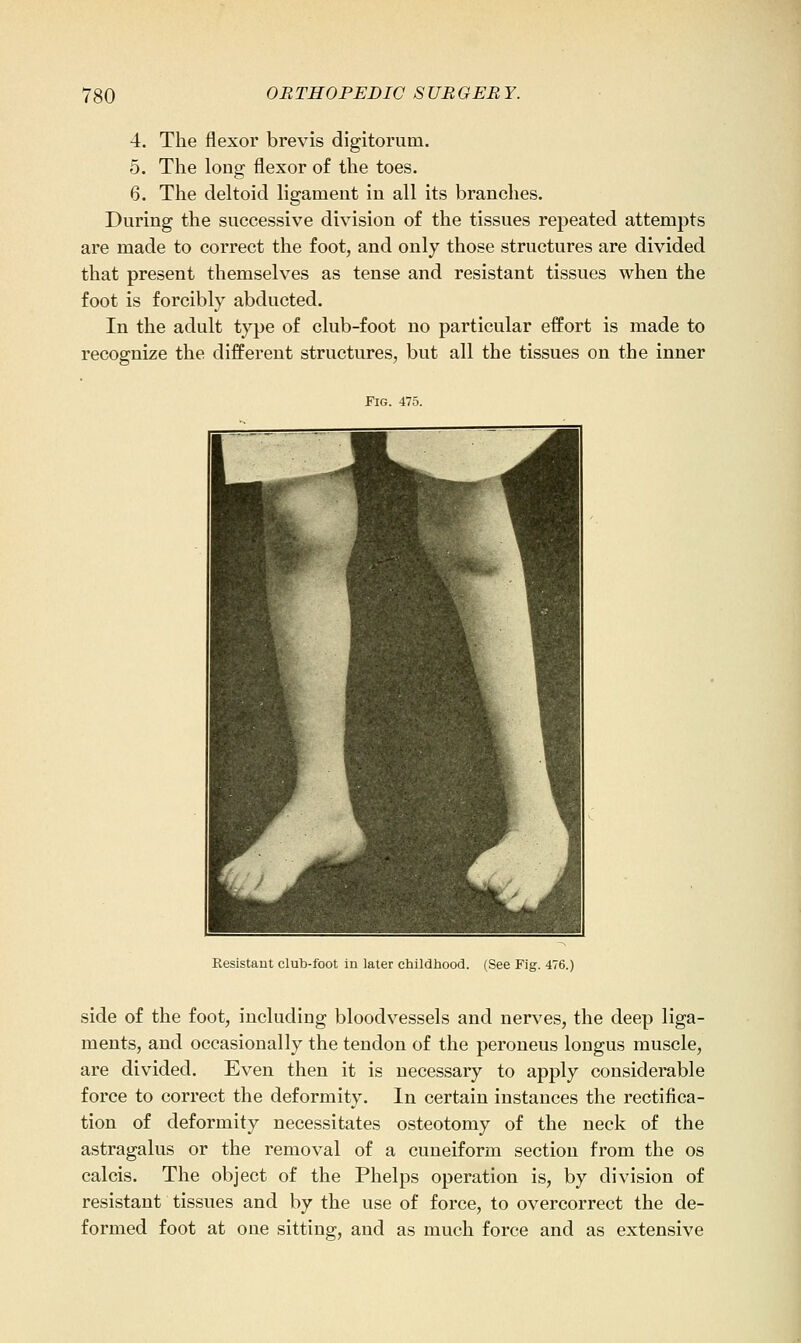 4. The flexor brevis digitorum. 5. The long flexor of the toes. 6. The deltoid ligament in all its branches. During the successive division of the tissues repeated attempts are made to correct the foot, and only those structures are divided that present themselves as tense and resistant tissues when the foot is forcibly abducted. In the adult type of club-foot no particular effort is made to recognize the different structures, but all the tissues on the inner Fig. 475. Resistant club-foot in later childhood. (See Fig. 476.; side of the foot, including bloodvessels and nerves, the deep liga- ments, and occasionally the tendon of the peroneus longus muscle, are divided. Even then it is necessary to apply considerable force to correct the deformity. In certain instances the rectifica- tion of deformity necessitates osteotomy of the neck of the astragalus or the removal of a cuneiform section from the os calcis. The object of the Phelps operation is, by division of resistant tissues and by the use of force, to overcorrect the de- formed foot at one sitting, and as much force and as extensive