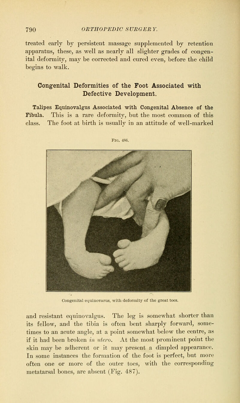 treated early by persistent massage supplemented by retention apparatus, these, as well as nearly all slighter grades of congen- ital deformity, may be corrected and cured even, before the child begins to walk. Congenital Deformities of the Foot Associated with Defective Development. Talipes Equinovalgus Associated with Congenital Absence of the Fibula. This is a rare deformity, but the most common of this class. The foot at birth is usually in an attitude of well-marked Fig. 486. Congenital equinovarus, with deformity of the great toes. and resistant equinovalgus. The leg is somewhat shorter than its fellow, and the tibia is often bent sharply forward, some- times to an acute angle, at a point somewhat below the centre, as if it had been broken in utero. At the most prominent point the skin may be adherent or it may present a dimpled appearance. In some instances the formation of the foot is perfect, but more often one or more of the outer toes, with the corresponding metatarsal bones, are absent (Fig. 487).