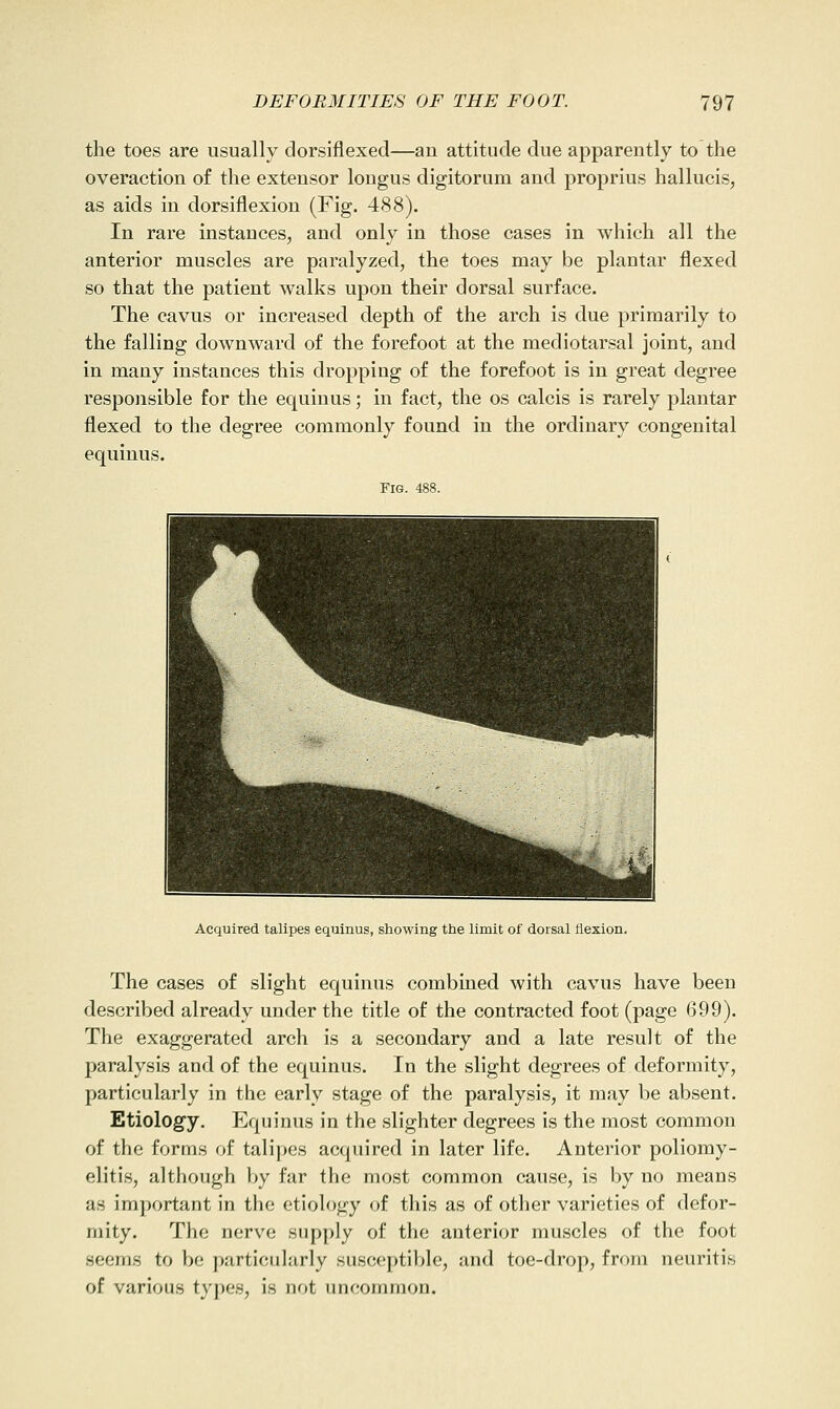 the toes are usually dorsiflexed—an attitude due apparently to the overaction of the extensor lougus digitorum and proprius hallucis, as aids in dorsiflexion (Fig. 488). In rare instances, and only in those cases in which all the anterior muscles are paralyzed, the toes may be plantar flexed so that the patient walks upon their dorsal surface. The cavus or increased depth of the arch is due primarily to the falling downward of the forefoot at the mediotarsal joint, and in many instances this dropping of the forefoot is in great degree responsible for the equinus; in fact, the os calcis is rarely plantar flexed to the degree commonly found in the ordinary congenital equinus. Fig. 488. Acquired talipes equinus, showing the limit of dorsal flexion. The cases of slight equinus combined with cavus have been described already under the title of the contracted foot (page 699). The exaggerated arch is a secondary and a late result of the paralysis and of the equinus. In the slight degrees of deformity, particularly in the early stage of the paralysis, it may be absent. Etiology. Equinus in the slighter degrees is the most common of the forms of talipes acquired in later life. Anterior poliomy- elitis, although by far the most common cause, is by no means as important in the etiology of this as of other varieties of defor- mity. The nerve supply of the anterior muscles of the foot seems to be particularly susceptible, and toe-drop, from neuritis of various types, is not uncommon.