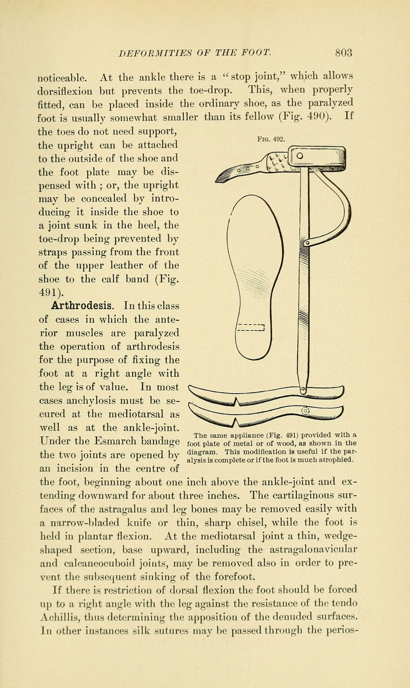 Fig. 492. noticeable. At the ankle there is a  stop joint/' which allows dorsiflexion but prevents the toe-drop. This, when properly fitted, can be placed inside the ordinary shoe, as the paralyzed foot is usually somewhat smaller than its fellow (Fig. 490). If the toes do not need support, the upright can be attached to the outside of the shoe and the foot plate may be dis- pensed with ; or, the upright may be concealed by intro- ducing it inside the shoe to a joint sunk in the heel, the toe-drop being prevented by straps passing from the front of the upper leather of the shoe to the calf band (Fig. 491). Arthrodesis. In this class of cases in which the ante- rior muscles are paralyzed the operation of arthrodesis for the purpose of fixing the foot at a right angle with the leg is of value. In most cases anchylosis must be se- cured at the mediotarsal as well as at the ankle-joint. TT 1 J.1 -r< 11 1 The same appliance (Fig. 491) provided with a Under the ii,smarch bandage foot plate of metal or of wood, as shown in the the two joints are opened by ^\^^'^?^- tms modification is useful if the par- J r J alysis IS complete or ifthe foot IS much atrophied. an incision in the centre of the foot, beginning about one inch above the ankle-joint and ex- tending downward for about three inches. The cartilaginous sur- faces of the astragalus and leg bones may be removed easily with a narrow-bladed knife or thin, sharp chisel, while the foot is held in plantar flexion. At the mediotarsal joint a thin, wedge- shaped section, base upward, including the astragalonavicular and calcaneocuboid joints, may be removed also in order to pre- vent the subsequent sinking of the forefoot. If there is restriction of dorsal flexion the foot should be forced up to a right angle with the leg against the resistance of the tendo Achillis, thus determining the apposition of the denuded surfaces. In other instances silk sutures may be passed through the perios-