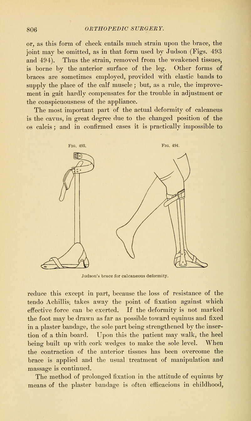 or, as this form of check entails much strain upon the brace, the joint may be omitted, as in that form used by Judson (Figs. 493 and 494). Thus the strain, removed from the weakened tissues, is borne by the anterior surface of the leg. Other forms of braces are sometimes employed, provided with elastic bands to supply the place of the calf muscle; but, as a rule, the improve- ment in gait hardly compensates for the trouble in adjustment or the conspicuousness of the appliance. The most important part of the actual deformity of calcaneus is the cavus, in great degree due to the changed position of the OS calcis; and in confirmed cases it is practically impossible to Fig. 493. Fig. 494. Judson's brace for calcaiieous deformity. reduce this except in part, because the loss of resistance of the tendo Achillis; takes away the point of fixation against which effective force can be exerted. If the deformity is not marked the foot may be drawn as far as possible toward equinus and fixed in a plaster bandage, the sole part being strengthened by the inser- tion of a thin board. Upon this the patient may walk, the heel being built up with cork wedges to make the sole level. When the contraction of the anterior tissues has been overcome the brace is applied and the usual treatment of manipulation and massage is continued. The method of prolonged fixation in the attitude of equinus by means of the plaster bandage is often efficacious in childhood.