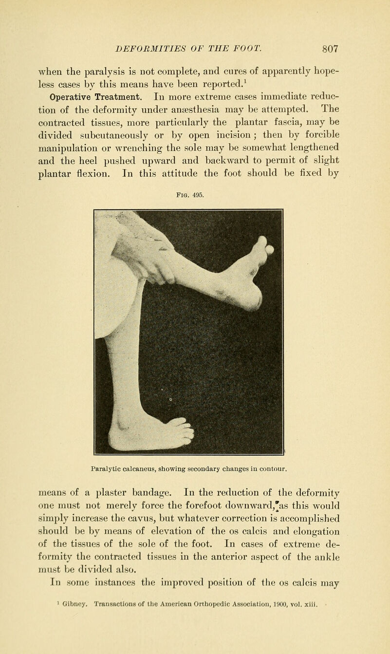 when the paralysis is not complete, and cures of apparently hope- less cases by this means have been reported/ Operative Treatment. In more extreme cases immediate reduc- tion o£ the deformity under anaesthesia may be attempted. The contracted tissues, more particularly the plantar fascia, may be divided subcutaneously or by open incision; then by forcible manipulation or wrenching the sole may be somewhat lengthened and the heel pushed upward and backward to permit of slight plantar flexion. In this attitude the foot should be fixed by Fig. 495. Paralytic calcaneus, showing secondary changes in contour. means of a plaster bandage. In the reduction of the deformity one must not merely force the forefoot downward,'as this would simply increase the cavus, but whatever correction is accomplished should be by means of elevation of the os calcis and elongation of the tissues of the sole of the foot. In cases of extreme de- formity the contracted tissues in the anterior aspect of the ankle must be divided also. In some instances the improved position of the os calcis may 1 Gibney. TranHactlons of the American Orthopedic Association, 1900, vol. xiii. ■