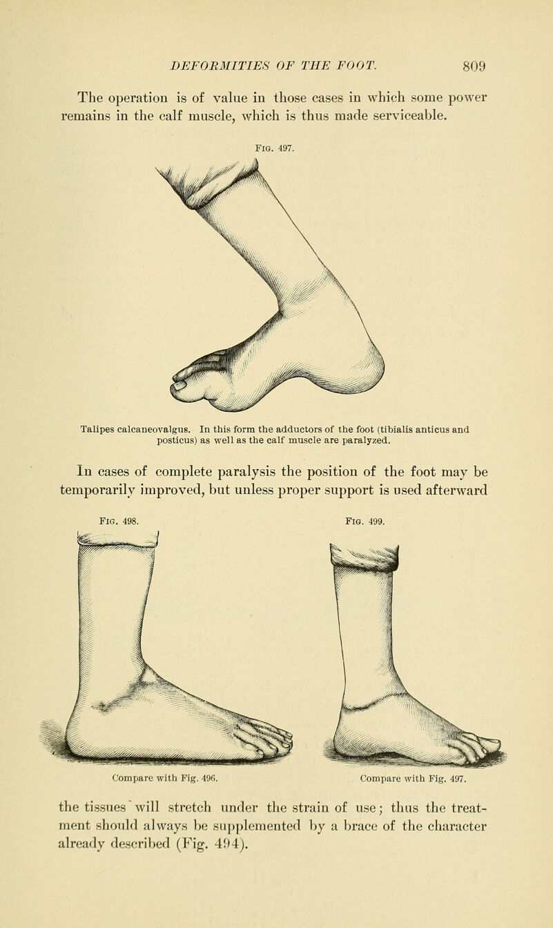 The operation is of value in those cases in which some power remains in the calf muscle, which is thus made serviceable. Fig. 497. Talipes calcaneovalgus. In this form the adductors of the foot (tibialis anticus and posticus) as well as the calf muscle are paralyzed. In cases of complete paralysis the position of the foot may be temporarily improved, but unless proper support is used afterward Fig. 498. Fig. 499. Compare with Fig. 49G. Compare with Fig. 497. the tissues will stretch under the strain of use; thus the treat- ment should always be supplemented by a brace of the character already described (Fig. 494).