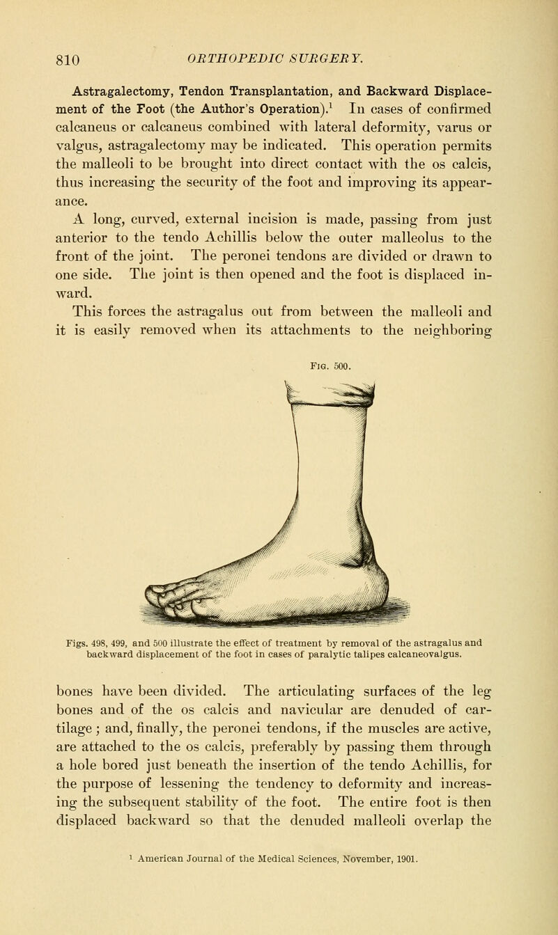 Astragalectomy, Tendon Transplantation, and Backward Displace- ment of the Foot (the Author's Operation),^ lu cases of confirmed calcaneus or calcaneus combined with lateral deformity, varus or valgus, astragalectomy may be indicated. This operation permits the malleoli to be brought into direct contact with the os calcis, thus increasing the security of the foot and improving its appear- ance. A long, curved, external incision is made, passing from just anterior to the tendo Achillis below the outer malleolus to the front of the joint. The peronei tendons are divided or drawn to one side. The joint is then opened and the foot is displaced in- ward. This forces the astragalus out from between the malleoli and it is easily removed when its attachments to the neighboring Fig. 500. Figs. 498, 499, and 500 illustrate the effect of treatment by removal of the astragalus and backward displacement of the foot in cases of paralytic talipes calcaneovalgus. bones have been divided. The articulating surfaces of the leg bones and of the os calcis and navicular are denuded of car- tilage ; and, finally, the peronei tendons, if the muscles are active, are attached to the os calcis, preferably by passing them through a hole bored just beneath the insertion of the tendo Achillis, for the purpose of lessening the tendency to deformity and increas- ing the subsequent stability of the foot. The entire foot is then displaced backward so that the denuded malleoli overlap the 1 American Journal of the Medical Sciences, November, 1901.