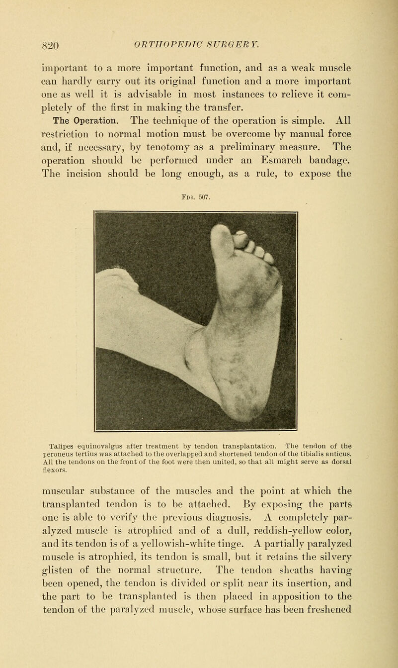 important to a more important function, and as a weak muscle can hardly carry out its original function and a more important one as well it is advisable in most instances to relieve it com- pletely of the first in making the transfer. The Operation. The technique of the operation is simple. All restriction to normal motion must be overcome by manual force and, if necessary, by tenotomy as a preliminary measure. The operation should be performed under an Esmarch bandage. The incision should be long enough, as a rule, to expose the Fn;. 507. ^ r ^^^^^v \ J Talipes equinovalgus after treatment by tendon transplantation. The tendon of the peroneus tertius was attached to the overlapped and shortened tendon of the tibialis anticus. All the tendons on the front of the foot were then united, so that all might serve as dorsal flexors. muscular substance of the muscles and the point at which the transplanted tendon is to be attached. By exposing the parts one is able to verify the previous diagnosis. A completely par- alyzed muscle is atrophied and of a dull, reddish-yellow color, and its tendon is of a yellowish-white tinge. A partially paralyzed muscle is atrophied, its tendon is small, but it retains the silvery glisten of the normal structure. The tendon sheaths having been opened, the tendon is divided or split near its insertion, and the part to be transplanted is then placed in apposition to the tendon of the paralyzed muscle, whose surface has been freshened