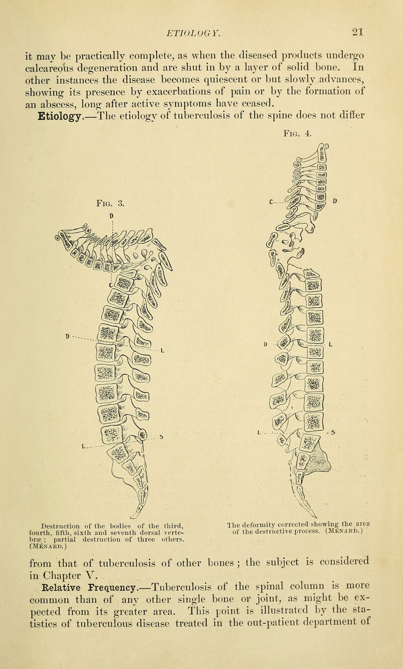 it may be practically complete, as when the diseased products undergo calcareotis degeneration and are shut in by a layer of solid bone. In other instances the disease becomes quiescent or but slowly advances, showing its presence by exacerbations of pain or by the formation of an abscess, long after active symptoms have ceased. Etiology.—The etiology of tuberculosis of the spine does not differ Fig. 4. DestFuction of the bodies of the third, fourth, fifth, sixth and seventh dorsal verte- brae ; partial destruction of three others. (M:6nard.) The deformity corrected showing the area of the destructive process. (Menaed.) from that of tuberculosis of other bones ; the subject is considered in Chapter V. Relative Frequency.—Tuberculosis of the spinal column is more common than of any other single bone or joint, as might be ex- pected from its greater area. This point is illustrated by the sta- tistics of tuberculous disease treated in the out-patient department of