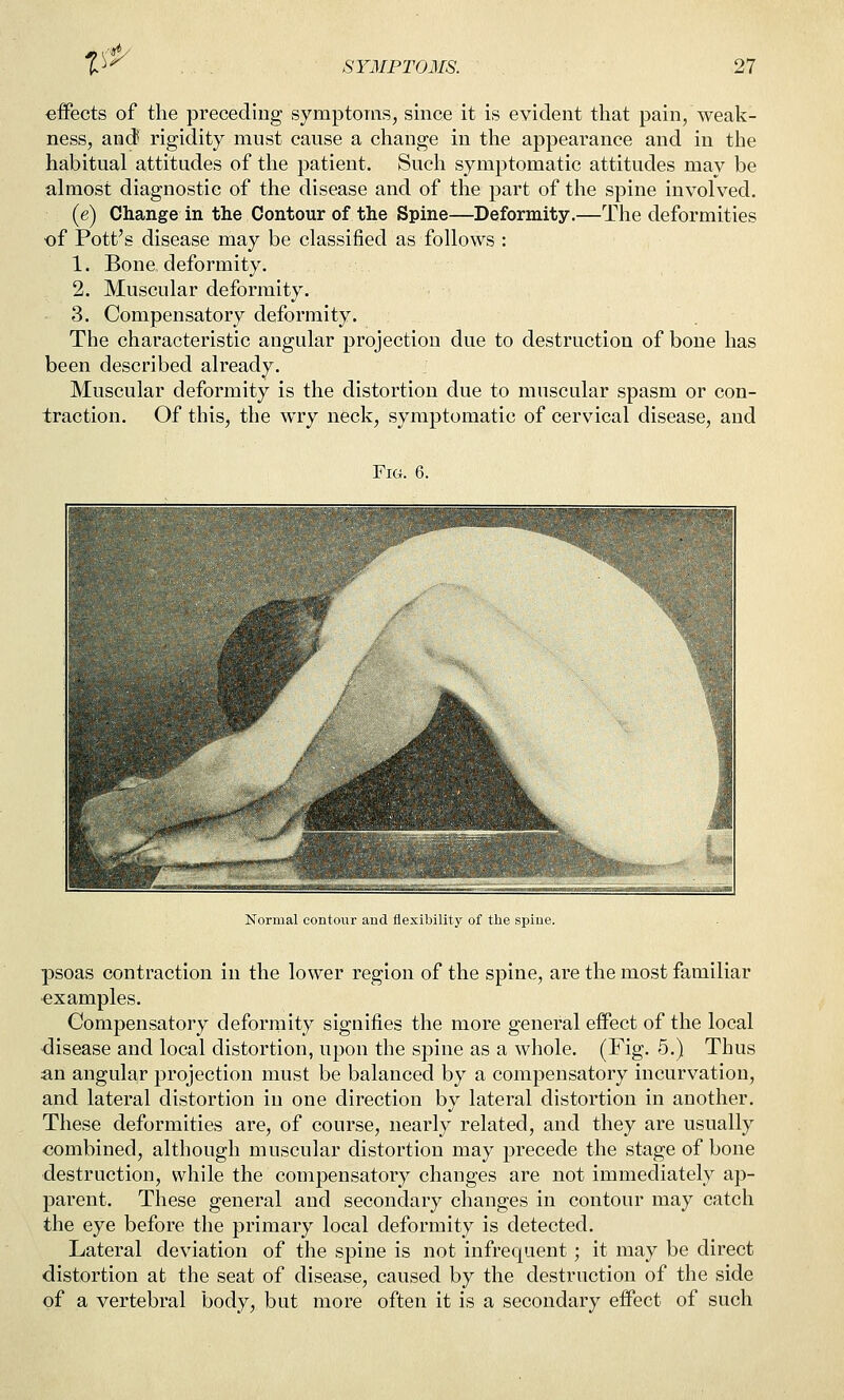 V'^ effects of the preceding symptoms, since it is evident that pain, weak- ness, and rigidity must cause a change in the appearance and in the habitual attitudes of the patient. Such symptomatic attitudes may be ahuost diagnostic of the disease and of the part of the spine involved. (e) Change in the Contour of the Spine—Deformity.—The deformities of Pott's disease may be classified as follows : 1. Bone deformity. 2. Muscular deformity. - 3. Compensatory deformity. The characteristic angular projection due to destruction of bone has been described already. Muscular deformity is the distortion due to muscular spasm or con- traction. Of this, the wry neck, symptomatic of cervical disease, and Fig. 6. Normal contour and flexibility of the spine. psoas contraction in the lower region of the spine, are the most familiar ■examples. Compensatory deforniity signifies the more general effect of the local disease and local distortion, upon the spine as a whole. (Fig. 5.) Thus an angula;r projection must be balanced by a compensatory incurvation, and lateral distortion in one direction by lateral distortion in another. These deformities are, of course, nearly related, and they are usually combined, although muscular distortion may precede the stage of bone destruction, while the compensatory changes are not immediately ap- parent. These general and secondary changes in contour may catch the eye before the primary local deformity is detected. Lateral deviation of the spine is not infrequent ; it may be direct distortion at the seat of disease, caused by the destruction of the side of a vertebral body, but more often it is a secondary effect of such