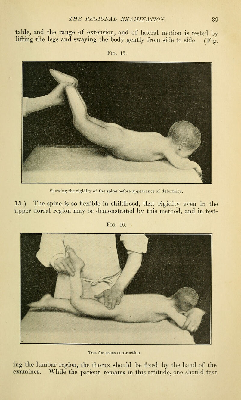 table, and the range of extension, and of lateral motion is tested by- lifting tHe legs and swaying the body gently from side to side. (Fig. Fig. 15. Showing the rigidity of the spine before appearance of deformity. 15.) The spine is so flexible in childhood, that rigidity even in the upper dorsal region may be demonstrated by this method, and in test- FiG. 16. Test for psoas contraction. ing the lumbar region, the thorax should be fixed by the hand of the examiner. While the patient remains in this attitude, one should test