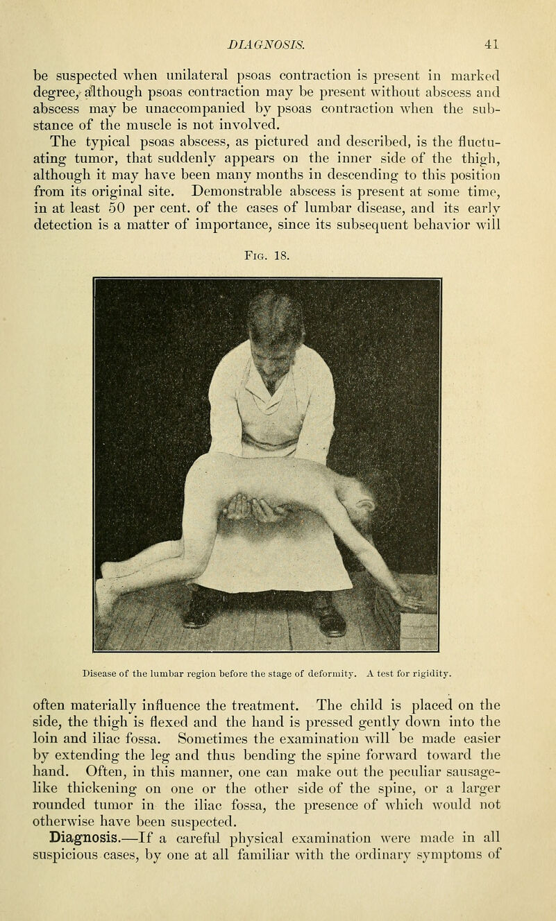 be suspected when unilateral psoas contraction is present in marked degree, although psoas contraction may be present without abscess and abscess may be unaccompanied by psoas contraction when the sub- stance of the muscle is not involved. The typical psoas abscess, as pictured and described, is the fluctu- ating tumor, that suddenly appears on the inner side of the thigh, although it may have been many months in descending to this position from its original site. Demonstrable abscess is present at some time, in at least 50 per cent, of the cases of lumbar disease, and its early detection is a matter of importance, since its subsequent behavior will Fig. 18. Disease of the lumbar region before the stage of deformity. A test for rigidity. often materially influence the treatment. The child is placed on the side, the thigh is flexed and the hand is pressed gently down into the loin and iliac fossa. Sometimes the examination will be made easier by extending the leg and thus bending the spine forward toward tlie hand. Often, in this manner, one can make out the peculiar sausage- like thickening on one or the other side of the spine, or a larger rounded tumor in the iliac fossa, the presence of which would not otherwise have been suspected. Diagnosis.—If a careful physical examination were made in all suspicious cases, by one at all familiar with the ordinary symptoms of