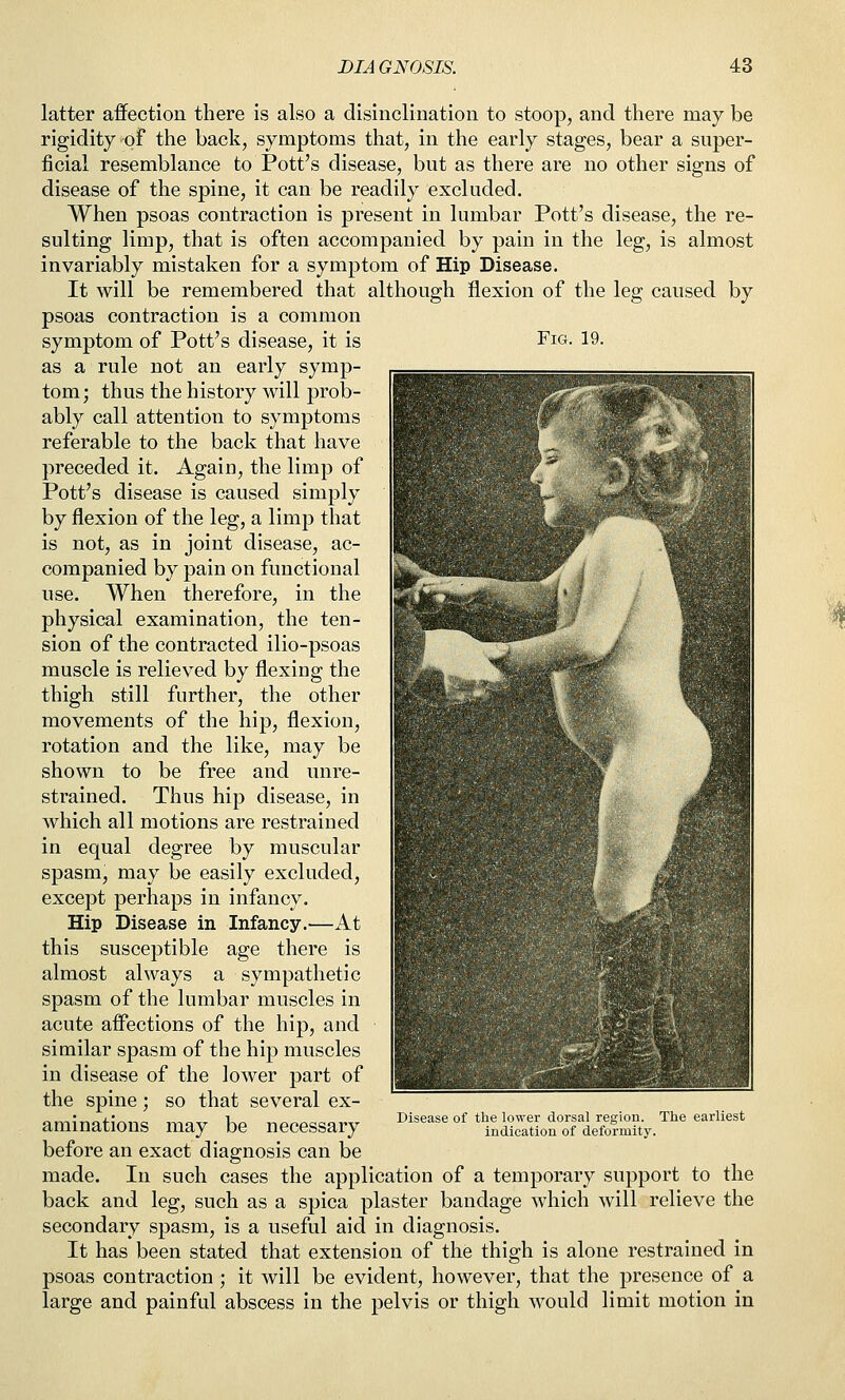 latter affection there is also a disinclination to stoop, and there may be rigidity of the back, symptoms that, in the early stages, bear a super- ficial resemblance to Pott's disease, but as there are no other signs of disease of the spine, it can be readily excluded. When psoas contraction is present in lumbar Pott's disease, the re- sulting limp, that is often accompanied by pain in the leg, is almost invariably mistaken for a symptom of Hip Disease. It will be remembered that although flexion of the leg caused by psoas contraction is a common symptom of Pott's disease, it is Fig. 19. as a rule not an early symp- tom; thus the history will prob- ably call attention to symptoms referable to the back that have preceded it. Again, the limp of Pott's disease is caused simply by flexion of the leg, a limp that is not, as in joint disease, ac- companied by pain on functional use. When therefore, in the physical examination, the ten- sion of the contracted ilio-psoas muscle is relieved by flexing the thigh still further, the other movements of the hip, flexion, rotation and the like, may be shown to be free and unre- strained. Thus hip disease, in which all motions are restrained in equal degree by muscular spasm, may be easily excluded, except perhaps in infancy. Hip Disease in Infancy.—At this susceptible age there is almost always a sympathetic spasm of the lumbar muscles in acute affections of the hip, and similar spasm of the hip muscles in disease of the lower part of the spine; so that several ex- aminations may be necessary before an exact diagnosis can be made. In such cases the application of a temporary support to the back and leg, such as a spica plaster bandage which will relieve the secondary spasm, is a useful aid in diagnosis. It has been stated that extension of the thigh is alone restrained in psoas contraction ; it will be evident, however, that the presence of a large and painful abscess in the pelvis or thigh would limit motion in Disease of the lower dorsal region. The earliest indication of deformity.