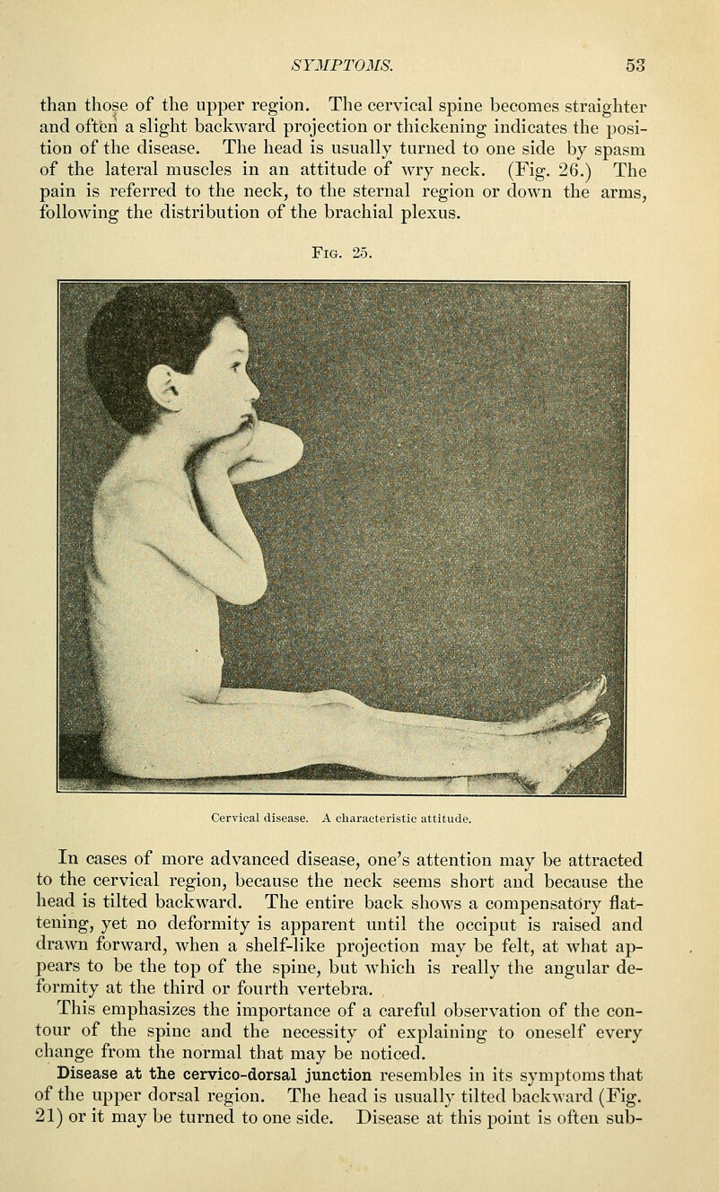 than those of the upper region. The cervical spine becomes straighter and often a slight backward projection or thickening indicates the posi- tion of the disease. The head is usually turned to one side by spasm of the lateral muscles in an attitude of wry neck. (Fig. 26.) The pain is referred to the neck, to the sternal region or down the arms, following the distribution of the brachial plexus. Fig. 25. Cervical disease. A characteristic attitude. In cases of more advanced disease, one's attention may be attracted to the cervical region, because the neck seems short and because the head is tilted backward. The entire back shows a compensatory flat- tening, yet no deformity is apparent until the occiput is raised and drawn forward, when a shelf-like projection may be felt, at what ap- pears to be the top of the spine, but which is really the angular de- formity at the third or fourth vertebra. This emphasizes the importance of a careful observation of the con- tour of the spine and the necessity of explaining to oneself every change from the normal that may be noticed. Disease at the cervico-dorsal junction resembles in its symptoms that of the upper dorsal region. The head is usually tilted backward (Fig. 21) or it may be turned to one side. Disease at this point is often sub-