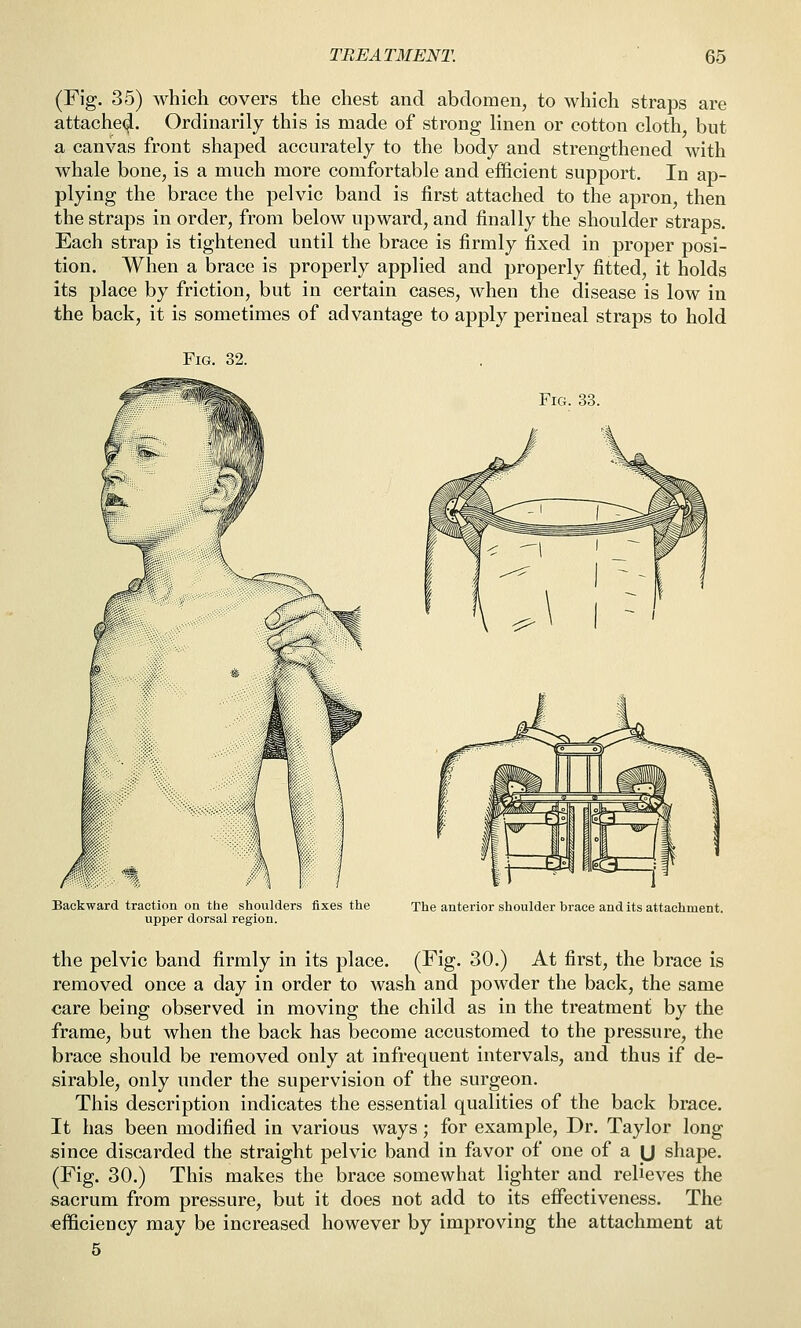 (Fig. 35) which covers the chest and abdomen, to which straps are attachec^. Ordinarily this is made of strong linen or cotton cloth, but a canvas front shaped accurately to the body and strengthened with whale bone, is a much more comfortable and efficient support. In ap- plying the brace the pelvic band is first attached to the apron, then the straps in order, from below upward, and finally the shoulder straps. Each strap is tightened until the brace is firmly fixed in proper posi- tion. When a brace is properly applied and properly fitted, it holds its place by friction, but in certain cases, when the disease is low in the back, it is sometimes of advantage to apply perineal straps to hold Fig. 32. Fig. 33. Backward traction on the shoulders fixes the upper dorsal region. The anterior shoulder brace and its attachment. the pelvic band firmly in its place. (Fig. 30.) At first, the brace is removed once a day in order to wash and powder the back, the same care being observed in moving the child as in the treatment by the frame, but when the back has become accustomed to the pressure, the brace should be removed only at infrequent intervals, and thus if de- sirable, only under the supervision of the surgeon. This description indicates the essential qualities of the back brace. It has been modified in various ways; for example. Dr. Taylor long since discarded the straight pelvic band in favor of one of a \J shape. (Fig. 30.) This makes the brace somewhat lighter and relieves the sacrum from pressure, but it does not add to its effectiveness. The efficiency may be increased however by improving the attachment at 5