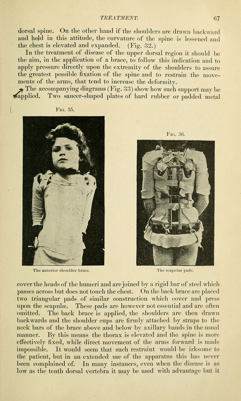 dorsal spine. On the other hand if the shoulders are drawn backward and held in this attitude, the curvature of the spine is lessened and the chest is elevated and expanded. (Fig. 32.) In the treatment of disease of the upper dorsal region it should be the aim, in the application of a brace, to follow this indication and to apply pressure directly upon the extremity of the shoulders to assure the greatest possible fixation of the spine and to restrain the move- ments of the arms, that tend to increase the deformity. The accompanying diagrams (Fig. 33) show how such support may be applied. Two saucer-shaped plates of hard rubber or padded metal Fig. 35. Fig. 36. The anterior shoulder brace. The scapular pads. cover the heads of the humeri and are joined by a rigid bar of steel which passes across but does not touch the chest. On the back brace are placed two triangular pads of similar construction which cover and press upon the scapulae. These pads are however not essential and are often omitted. The back brace is applied, the shoulders are then drawn backwards and the shoulder cups are firmly attached by straps to the neck bars of the brace above and below by axillary bands in the usual manner. By this means the thorax is elevated and the spine is more effectively fixed, while direct movement of the arms forward is made impossible. It would seem that such restraint would be irksome to the patient, but in an extended use of the apparatus this has never been complained of. In many instances, even when the disease is as low as the tenth dorsal vertebra it may be used with advantage but it